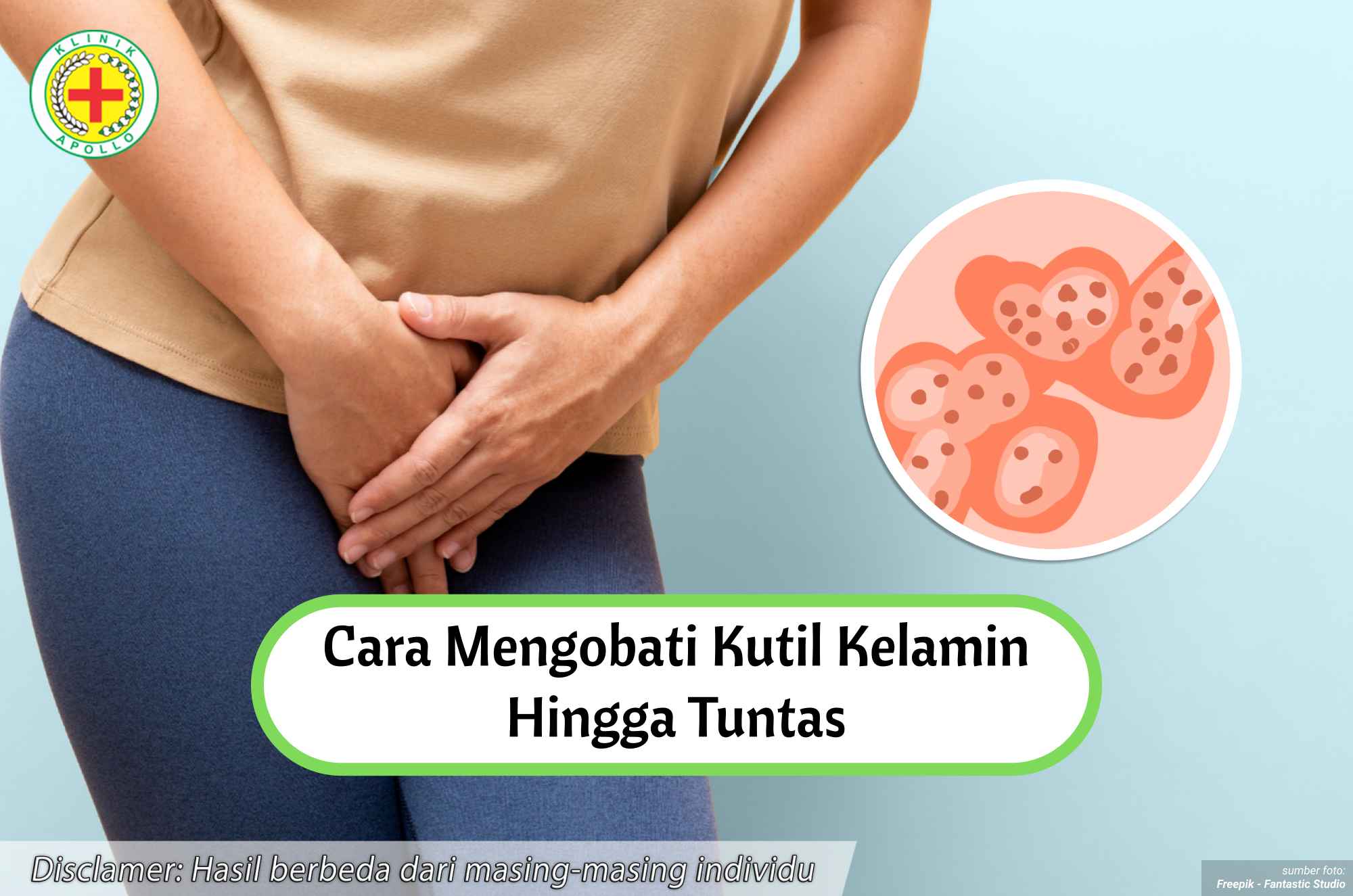 Ilustrasi Cara Mengobati Kutil Kelamin Hingga Tuntas.