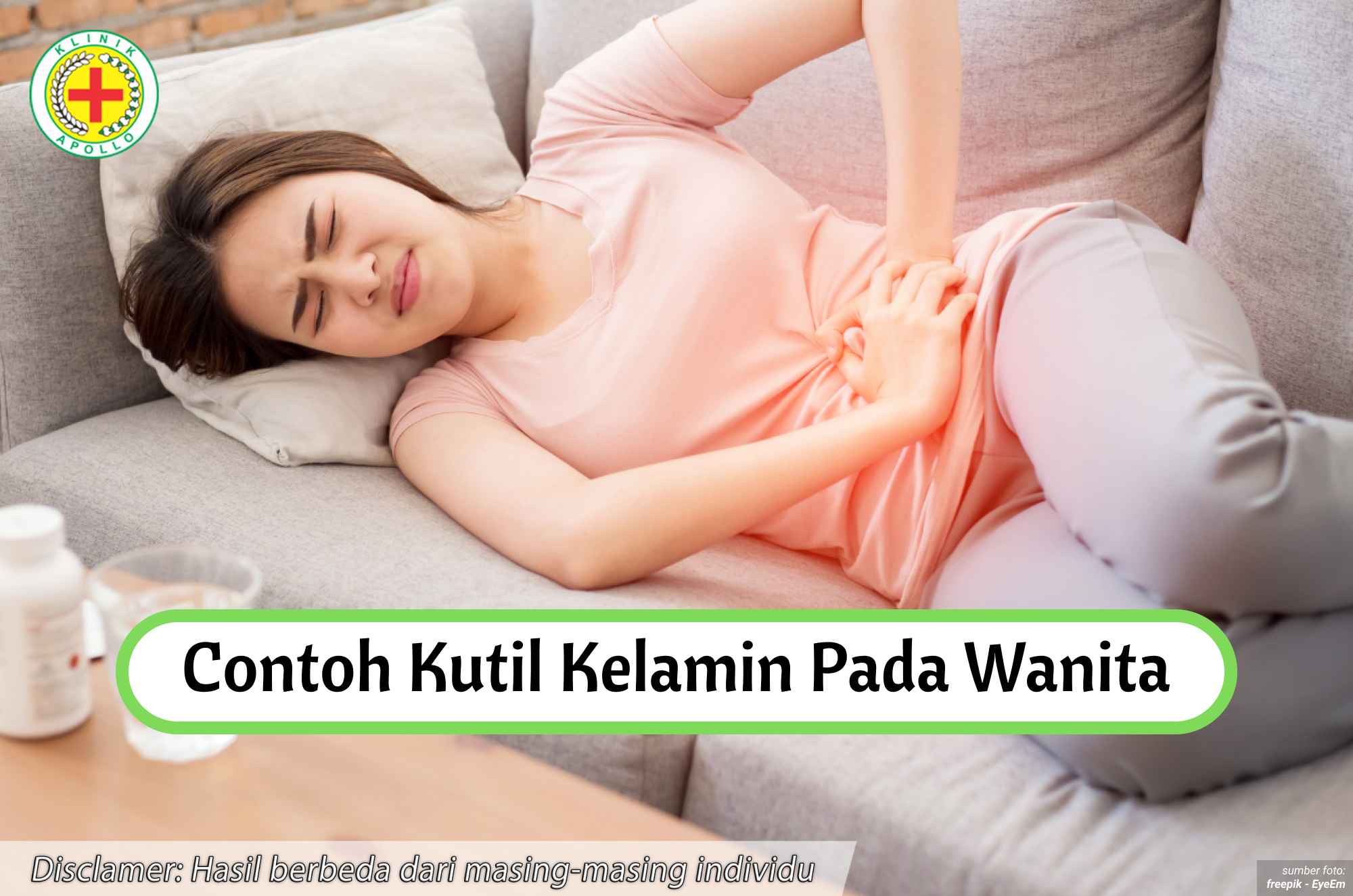 Ilustrasi Contoh Kutil Kelamin pada Wanita.