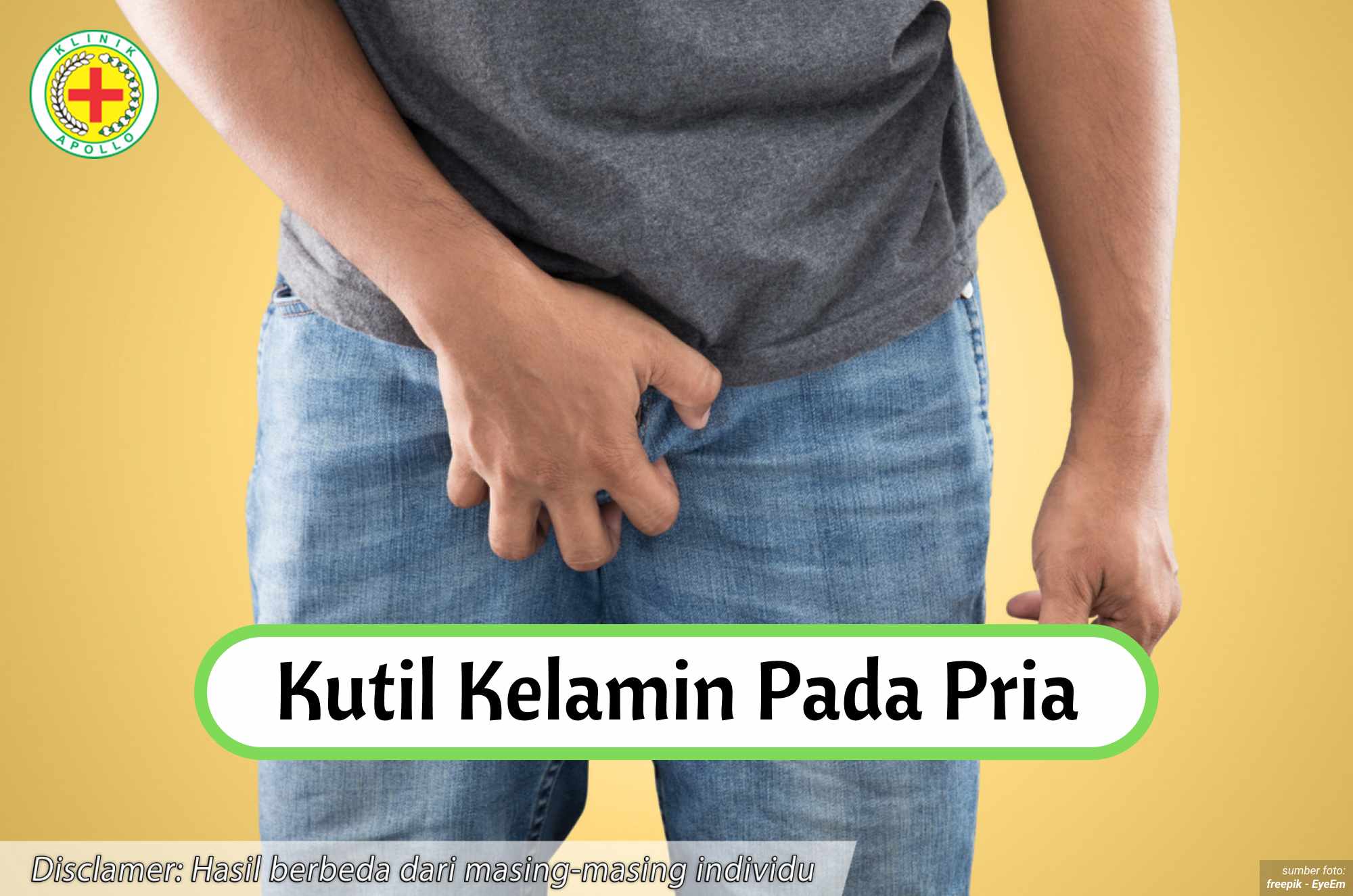 Ilustrasi Kutil Kelamin pada Pria.
