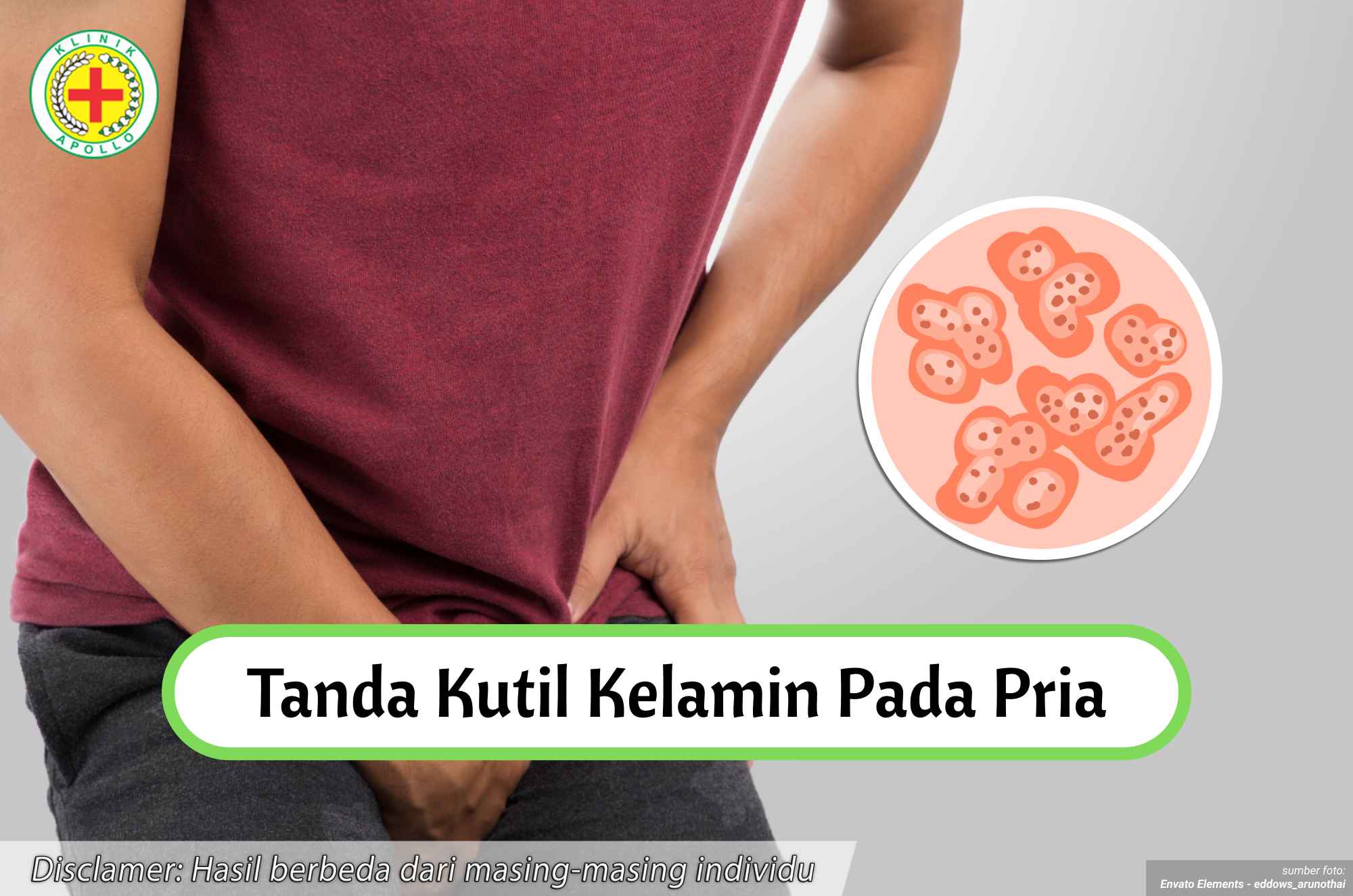 Ilustrasi Tanda Kutil Kelamin pada Pria.