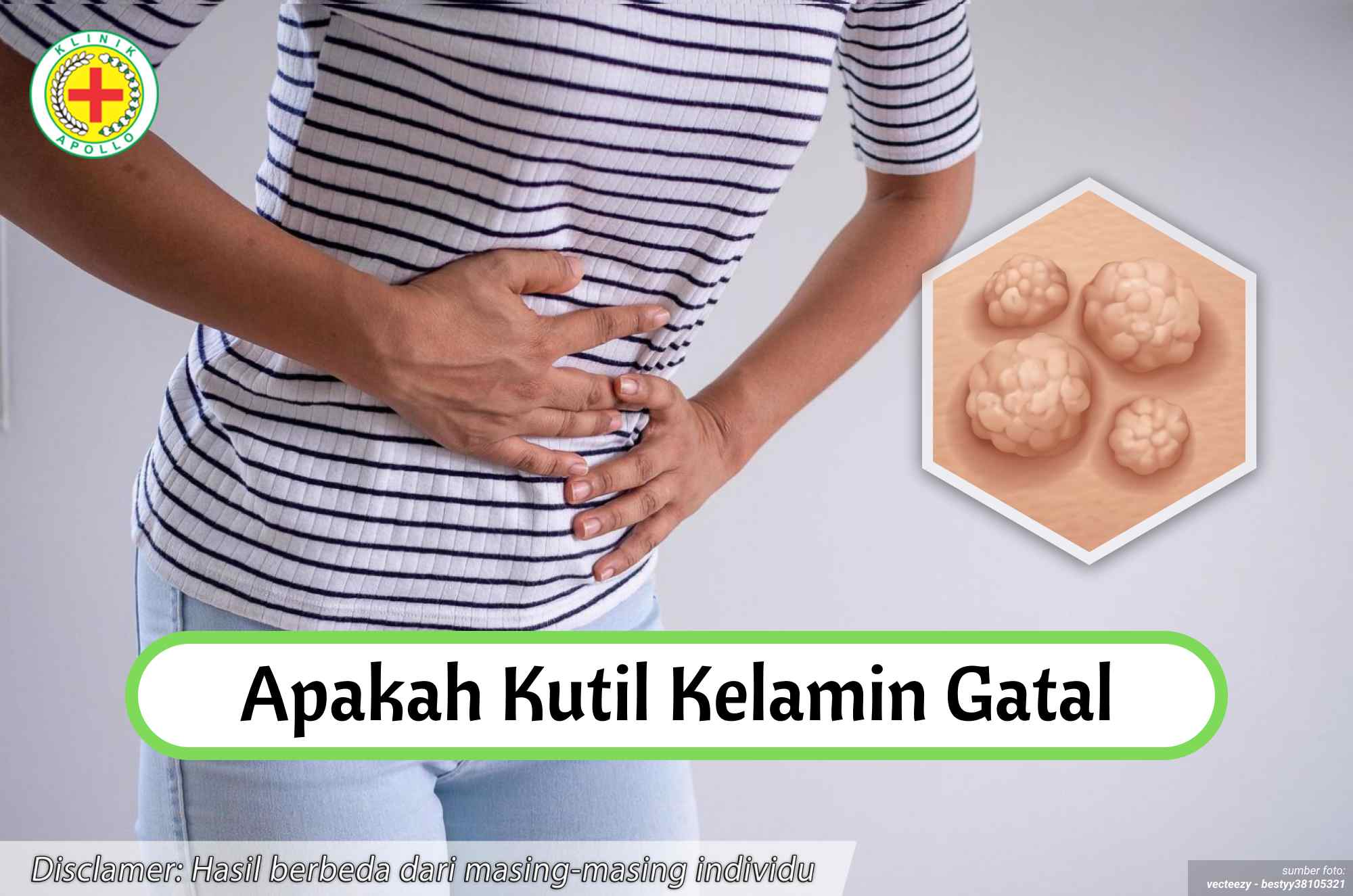 Ilustrasi Apakah Kutil Kelamin Gatal.