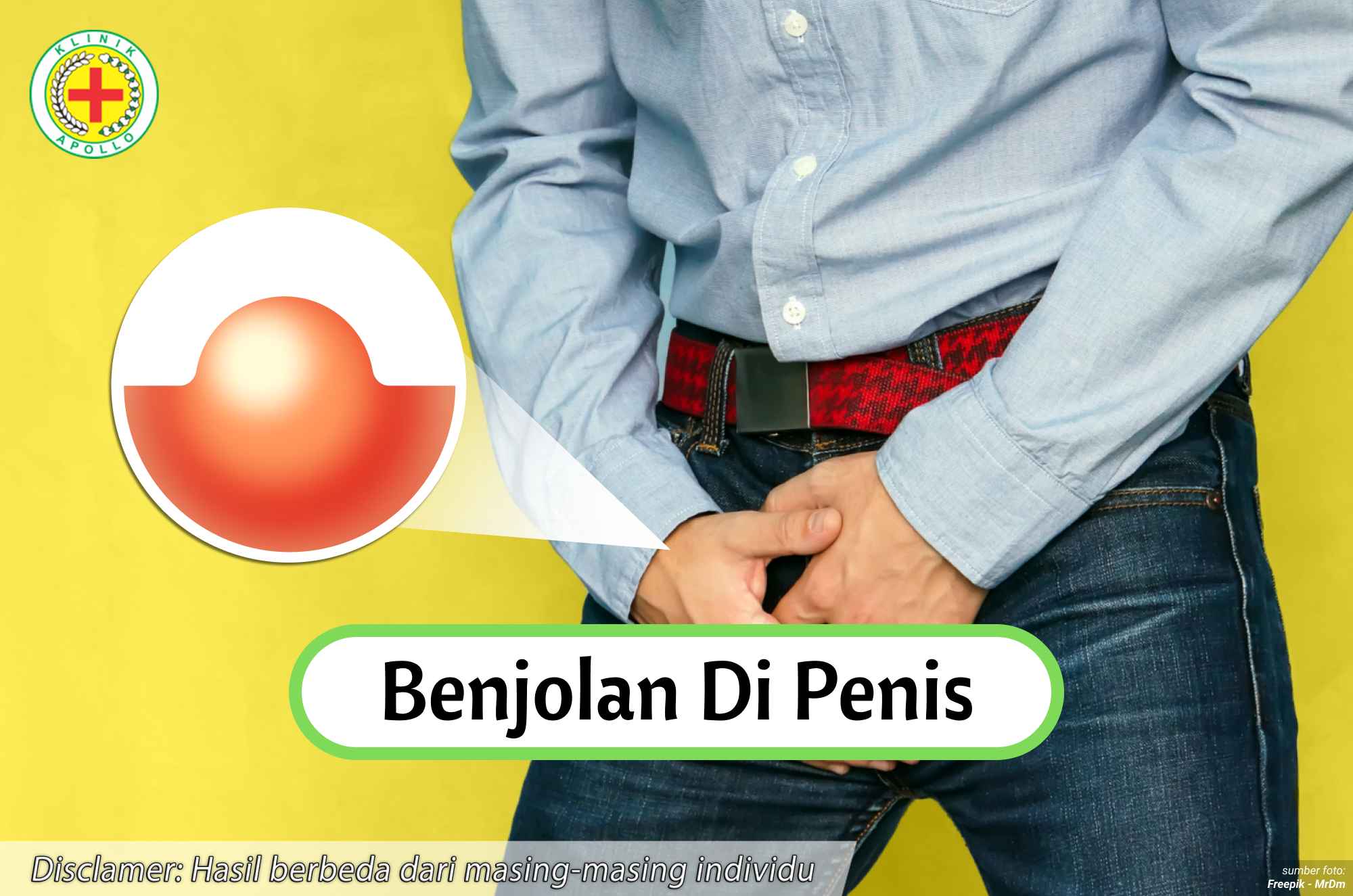 Ilustrasi Benjolan di Penis.