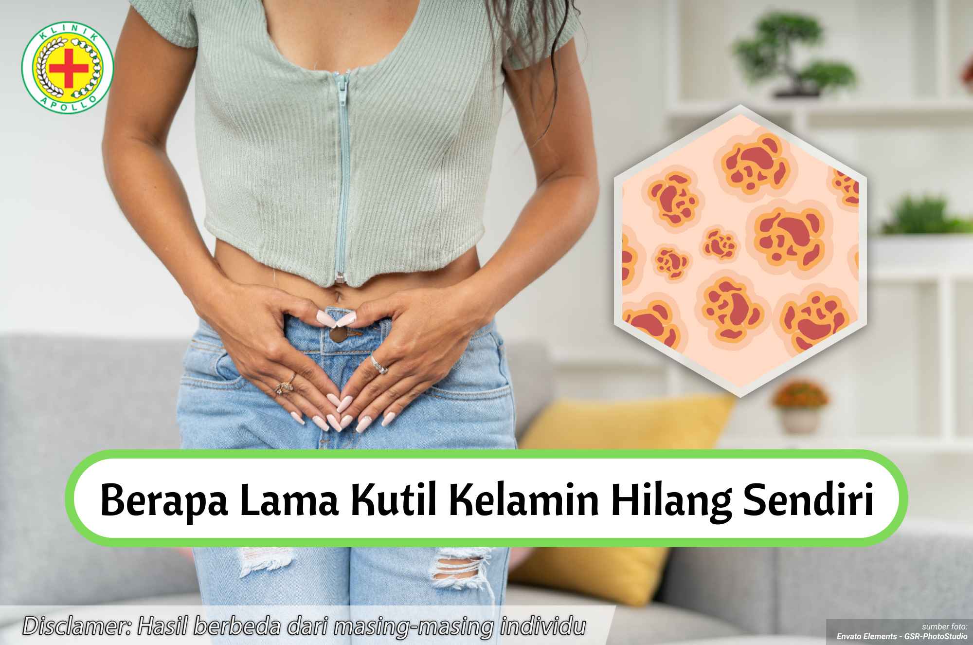 Ilustrasi Berapa Lama Kutil Kelamin Hilang.