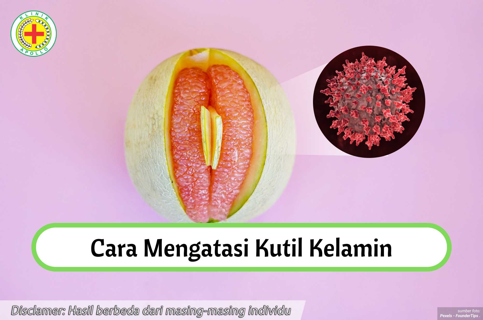 Ilustrasi Cara Mengatasi Kutil Kelamin.