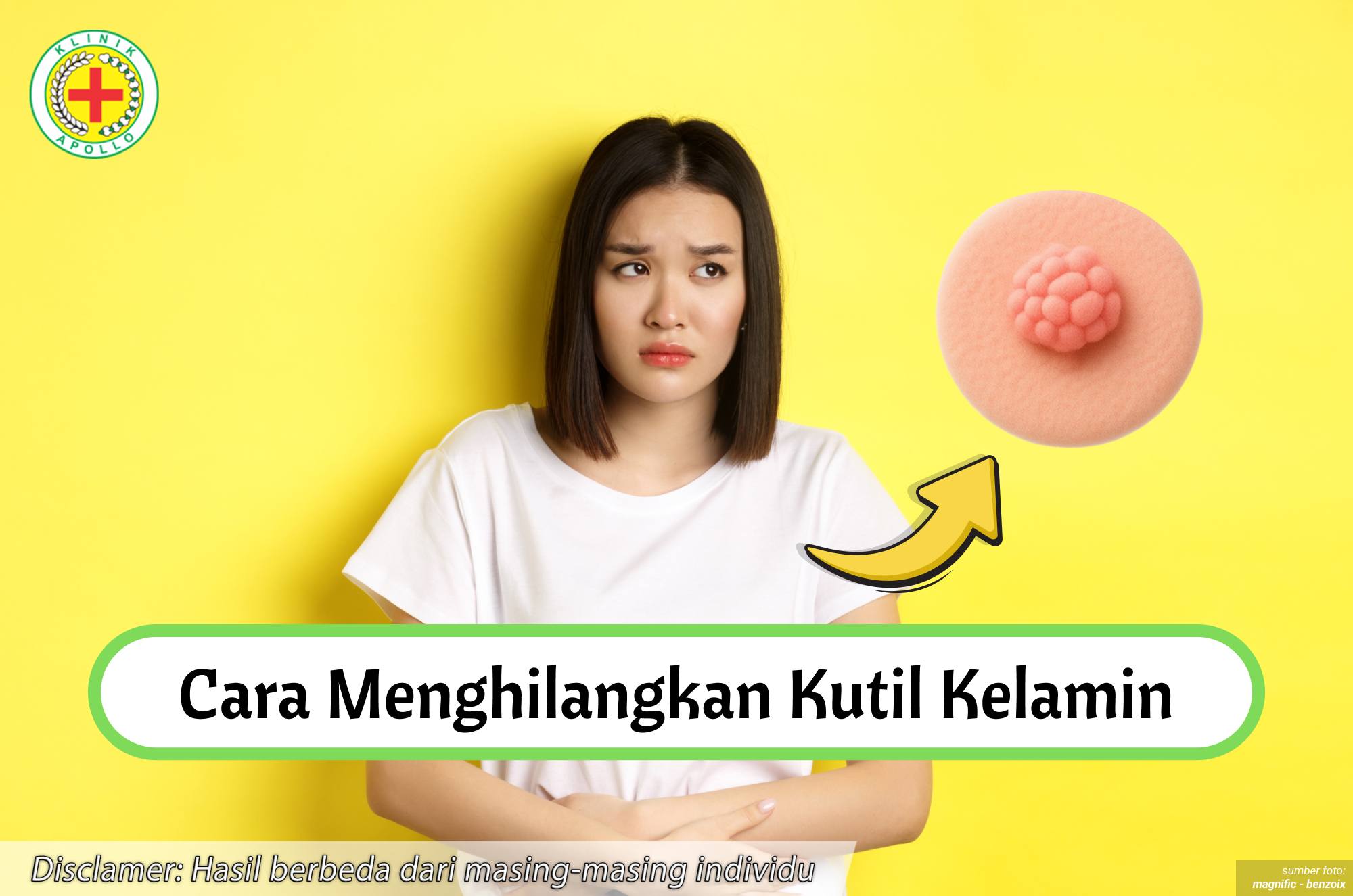 Ilustrasi Cara Menghilangkan Kutil Kelamin.