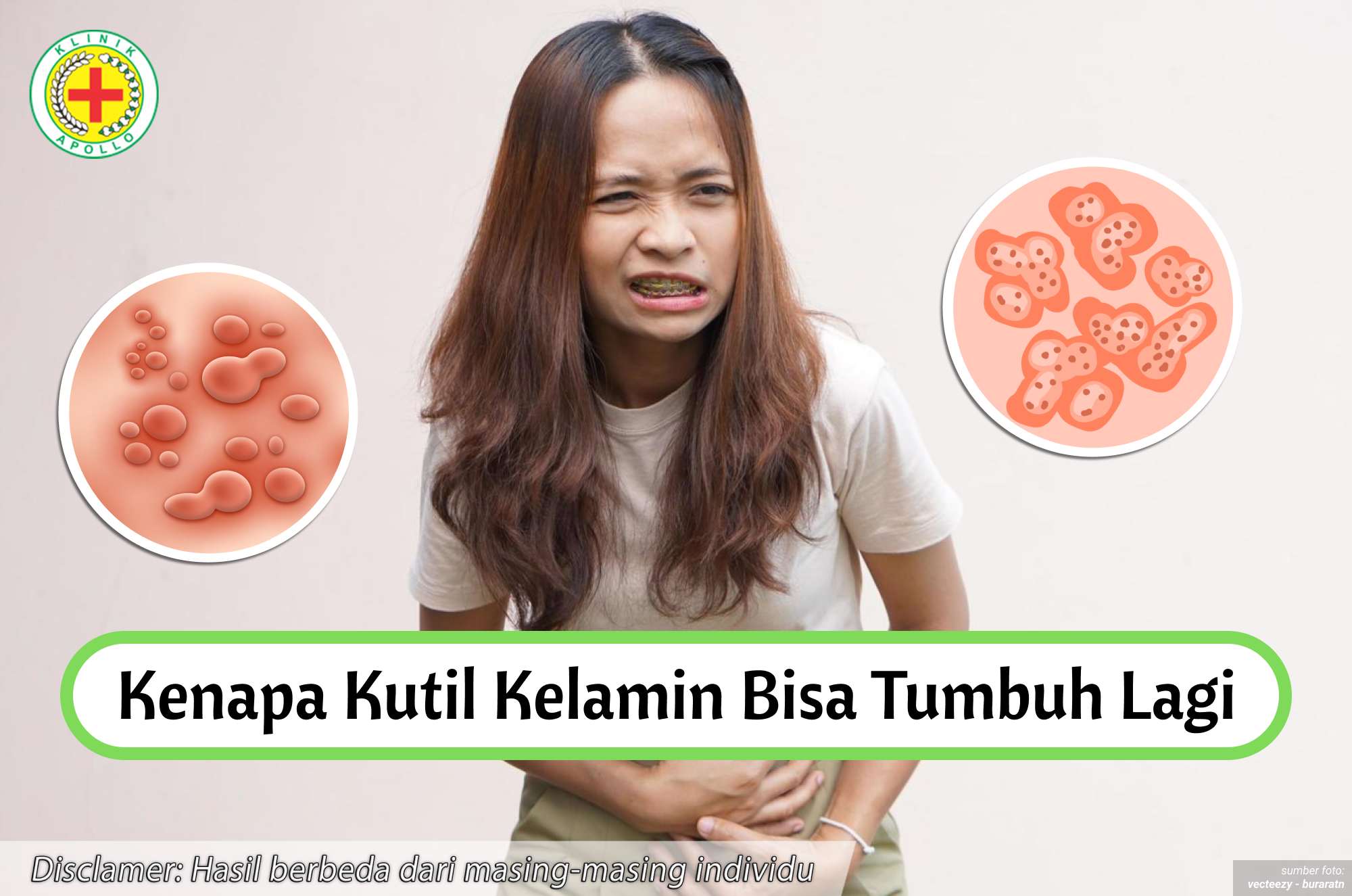 Ilustrasi Kenapa Kutil Kelamin Bisa Tumbuh Lagi.