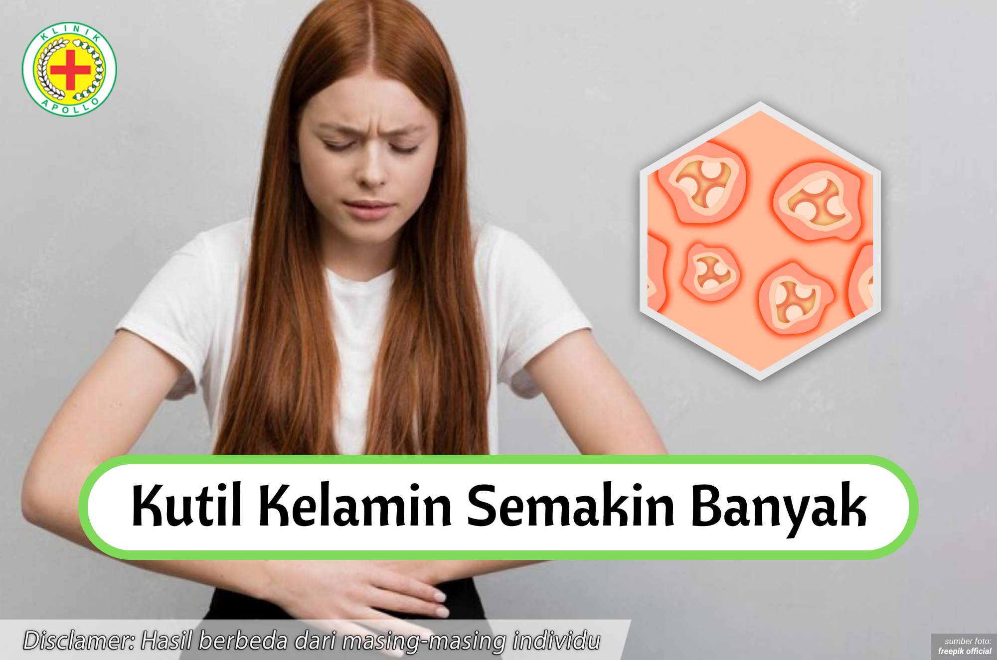 Ilustrasi Kenapa Kutil Kelamin Semakin Banyak.