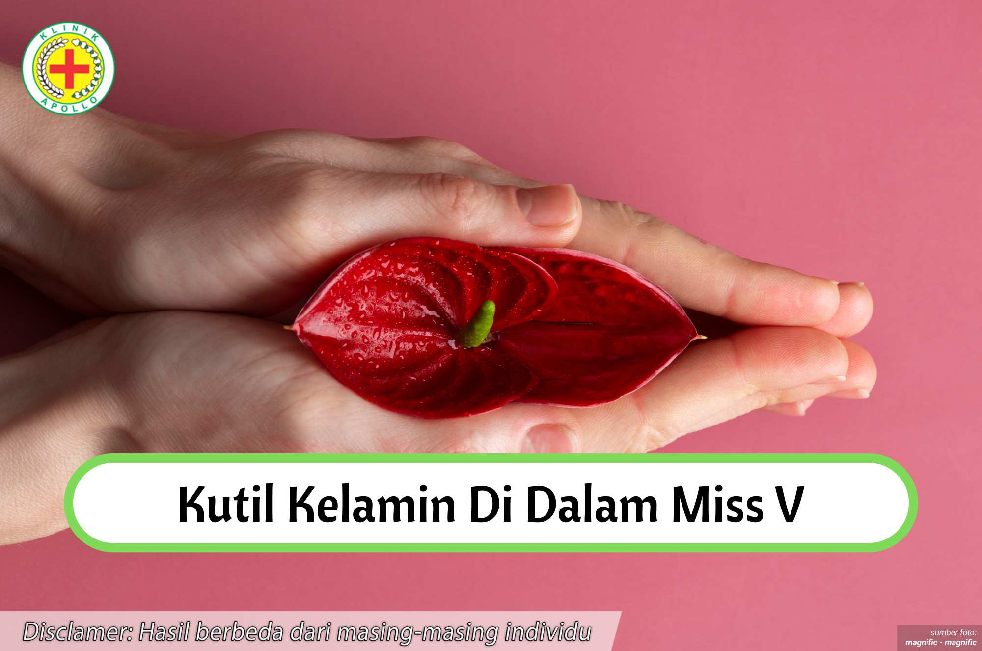 Ilustrasi Kutil Kelamin di Dalam Miss V.