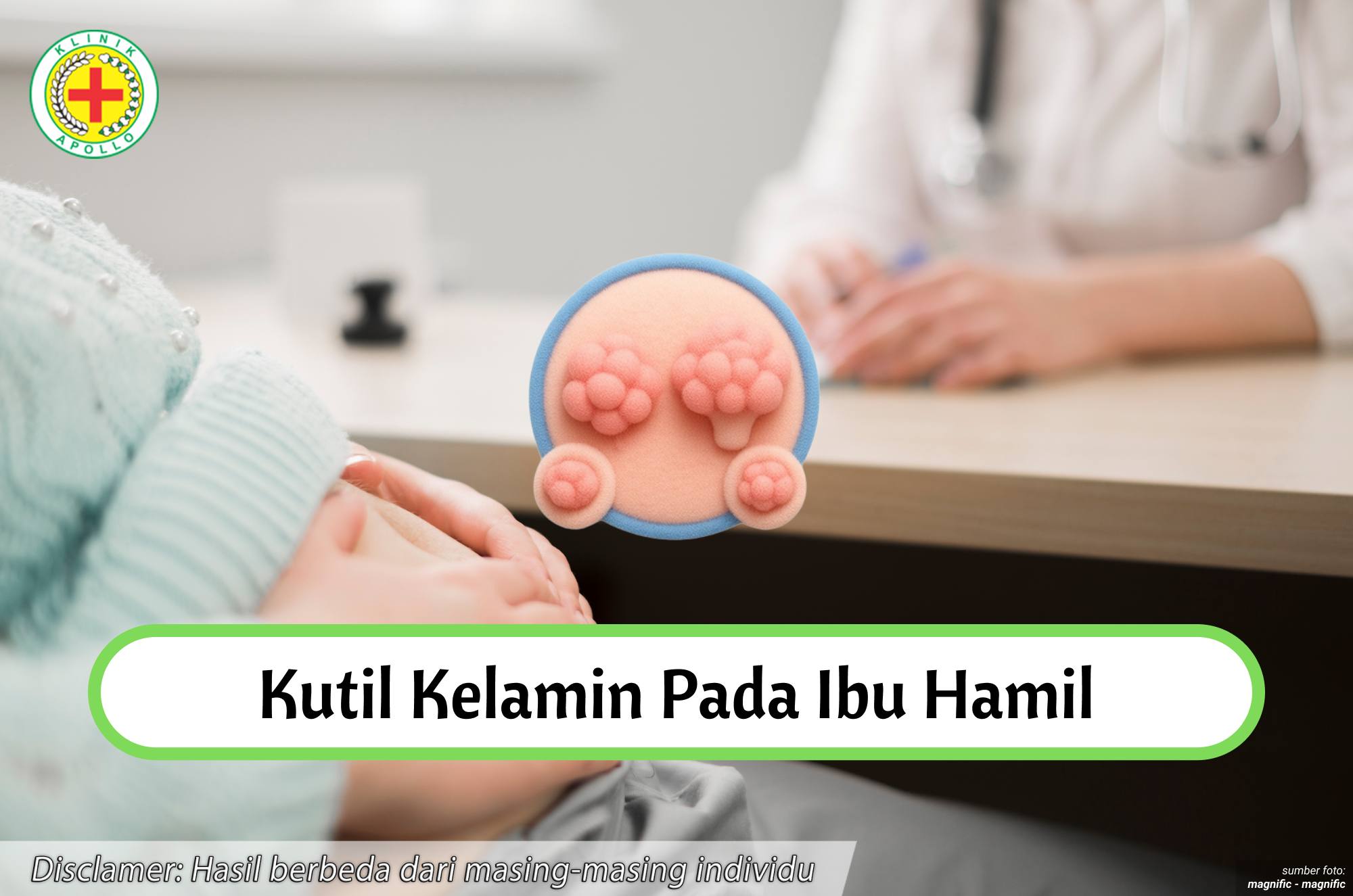 Ilustrasi Kutil Kelamin pada Ibu Hamil.