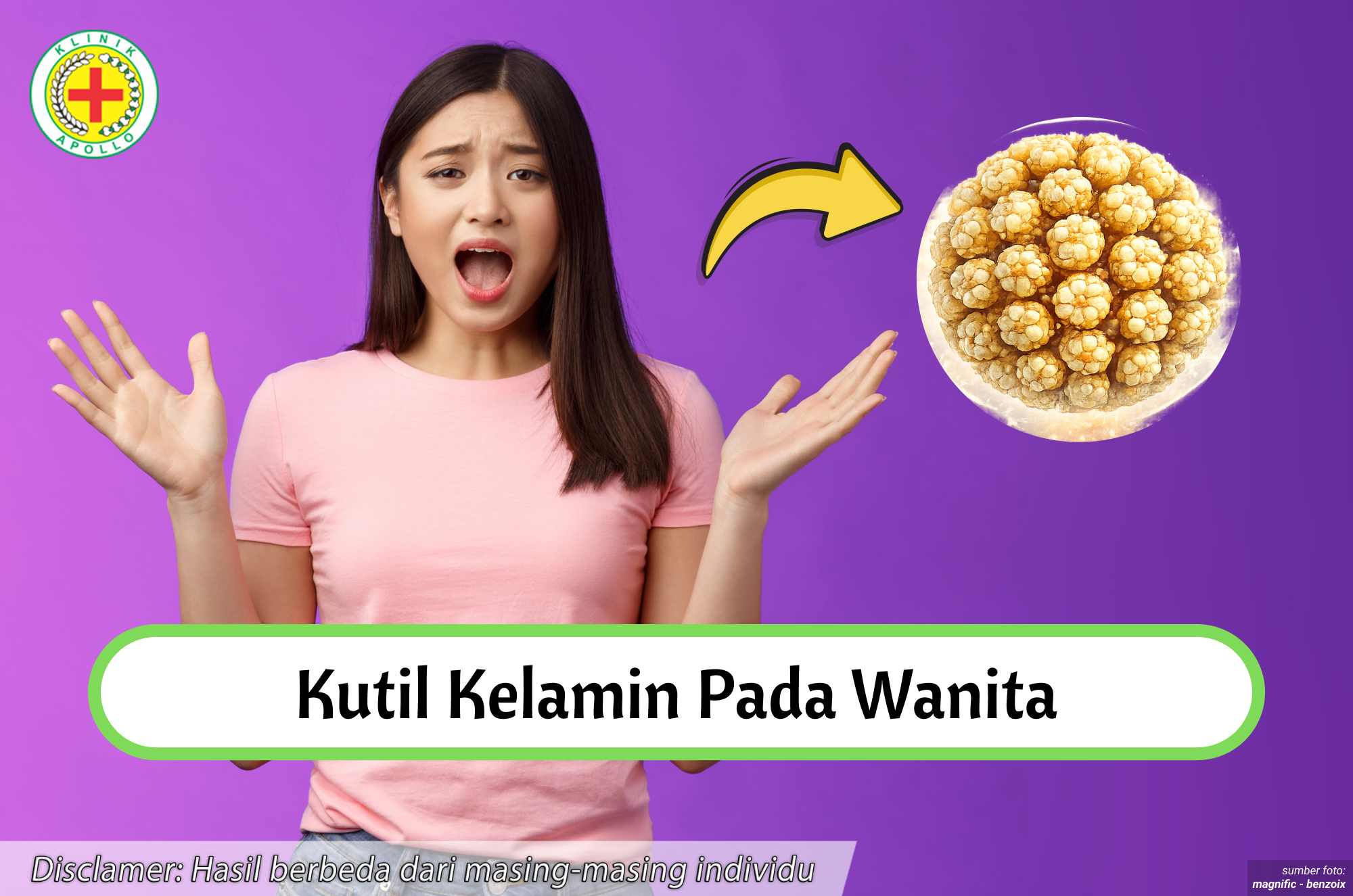 Ilustrasi Kutil Kelamin pada Wanita.