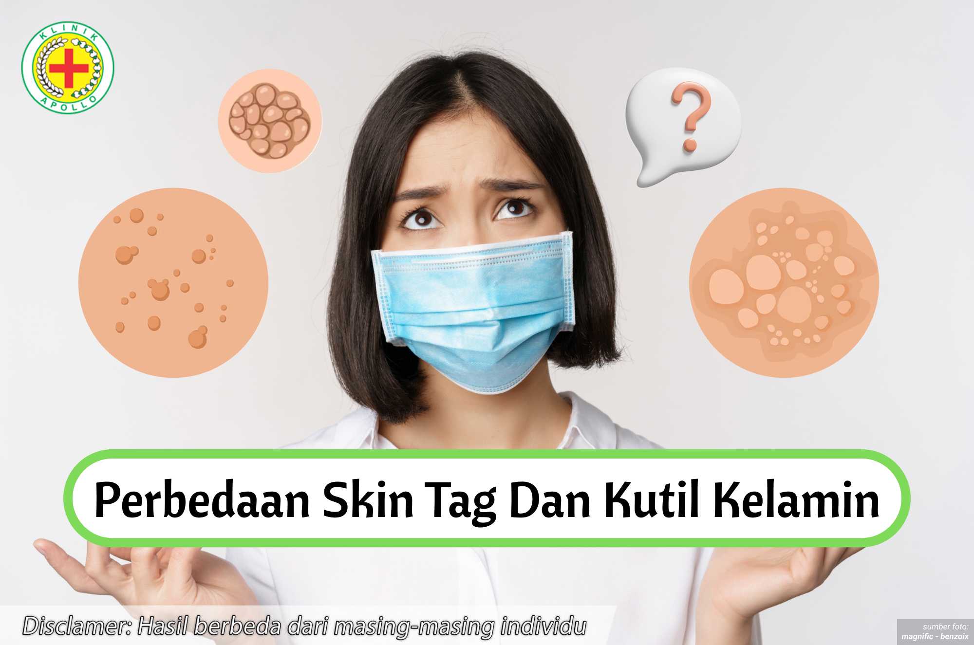 Ilustrasi Perbedaan Skin Tag dan Kutil Kelamin.