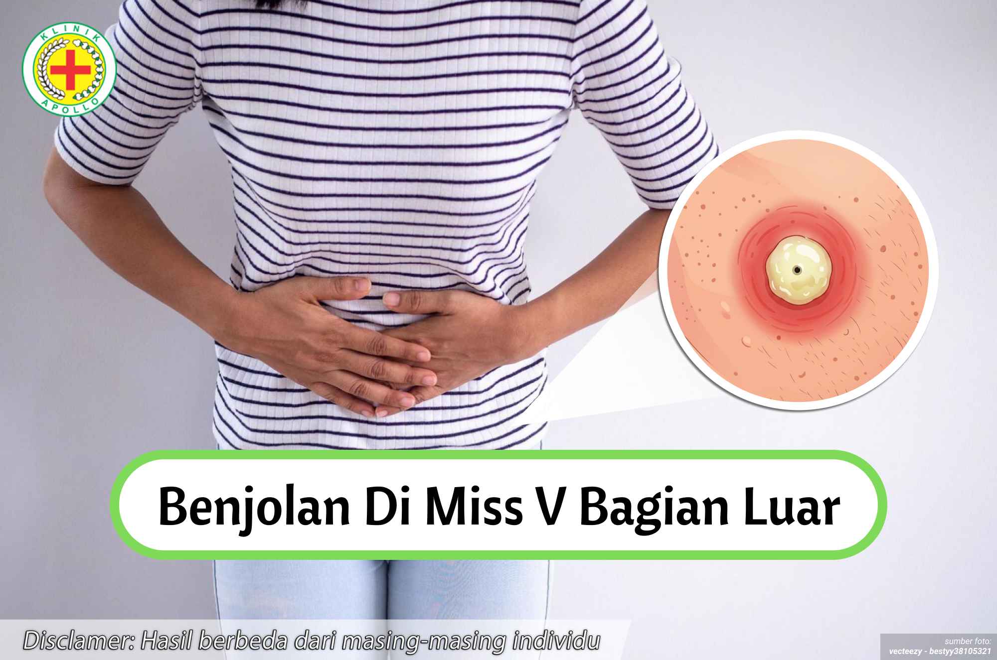 Ilustrasi Benjolan di Miss V Bagian Luar.