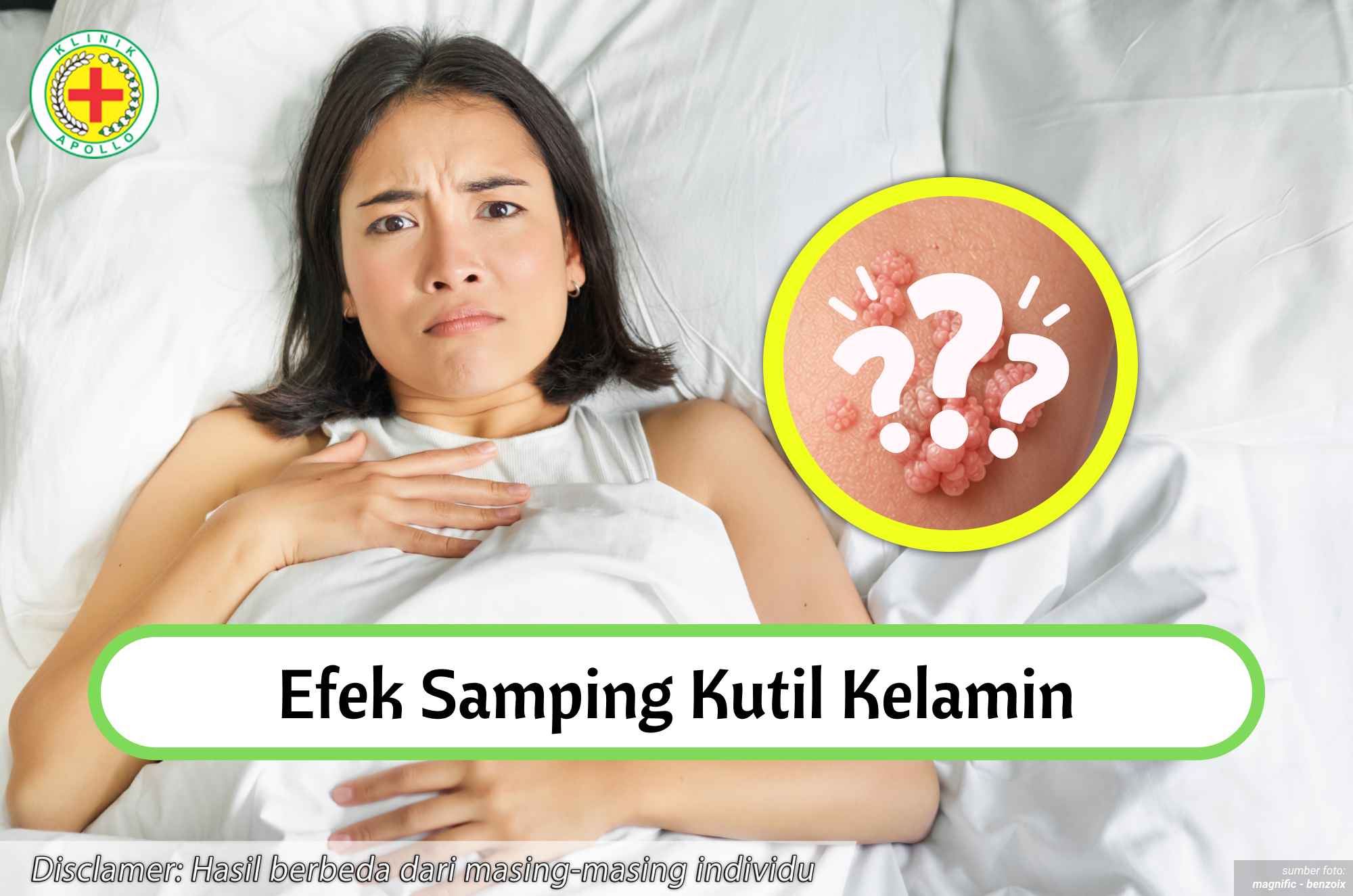 Ilustrasi Efek Samping Kutil Kelamin.
