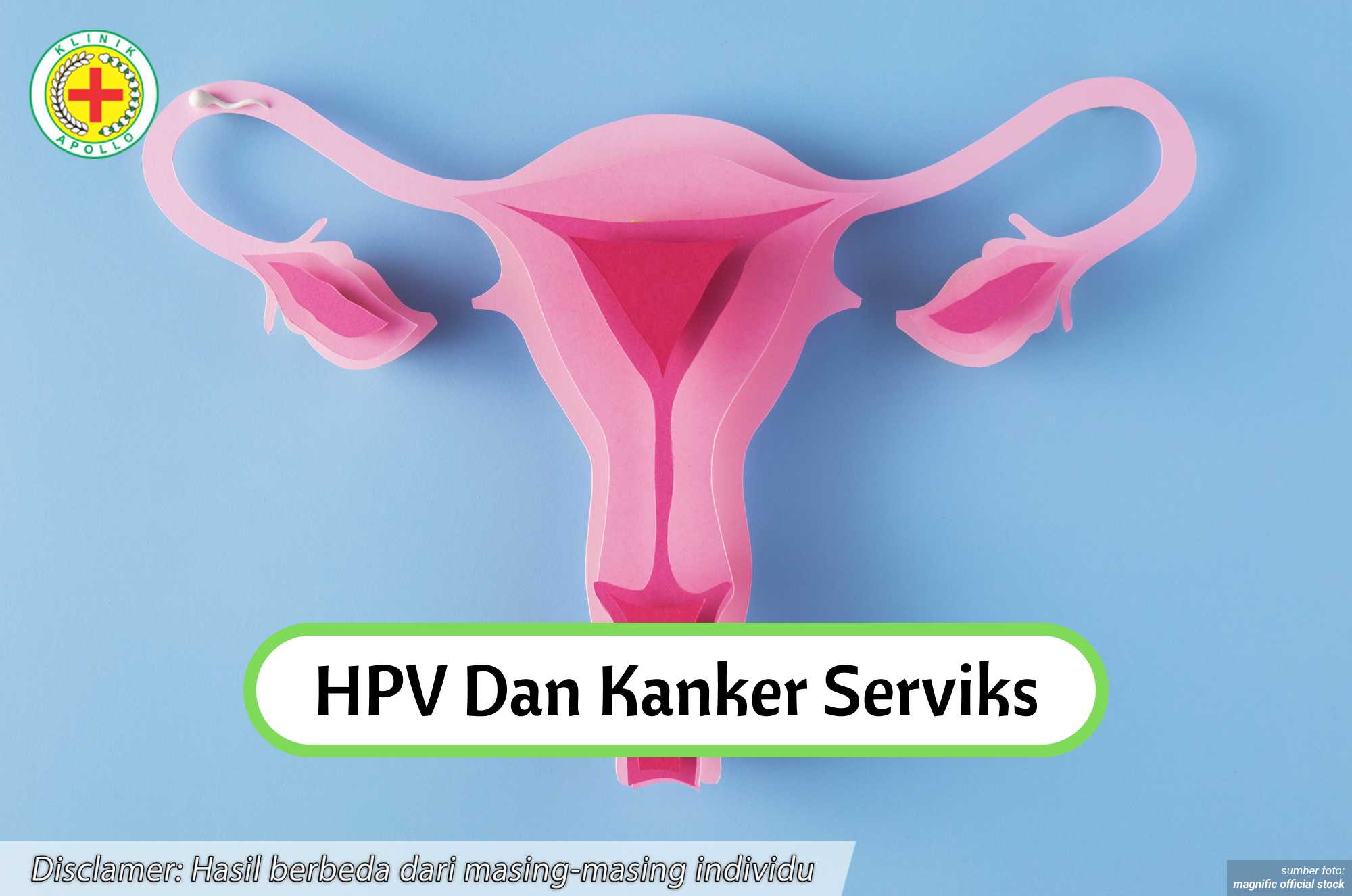 Ilustrasi HPV dan Kanker Serviks.