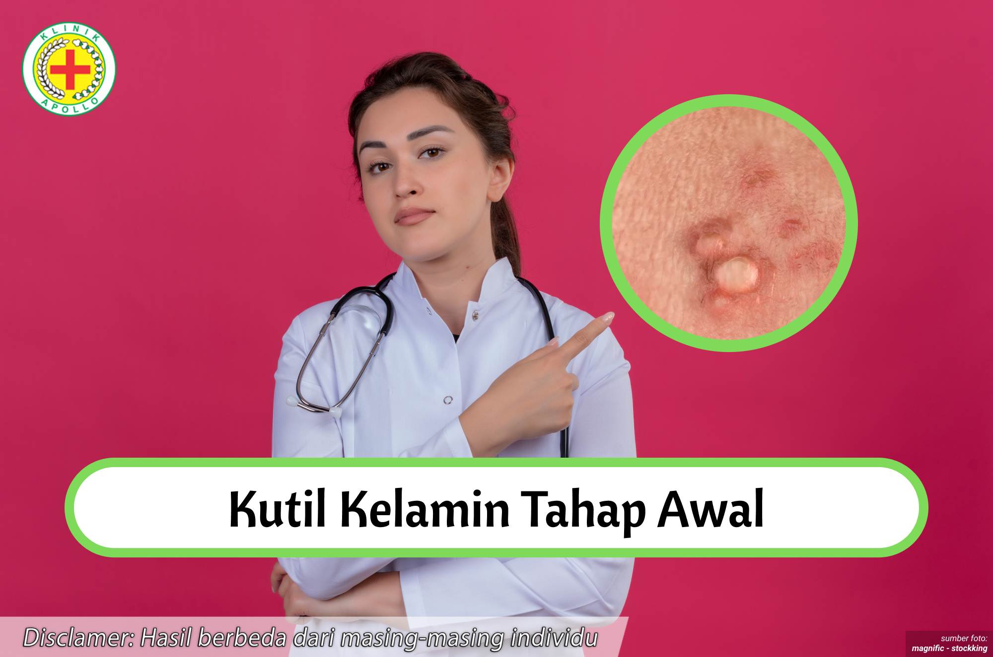 Ilustrasi Kutil Kelamin Tahap Awal.