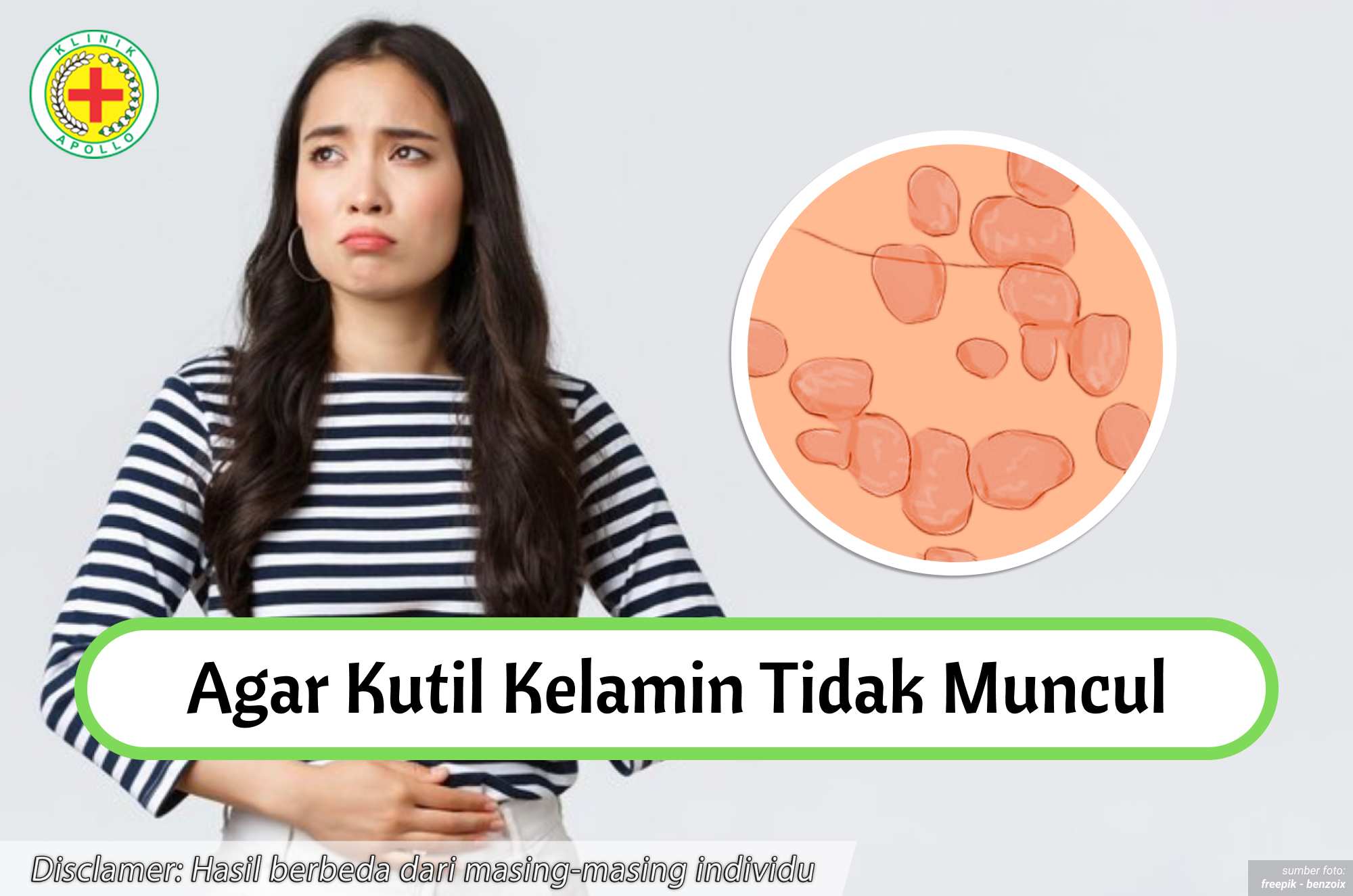 Ilustrasi Agar Kutil Kelamin Tidak Muncul.