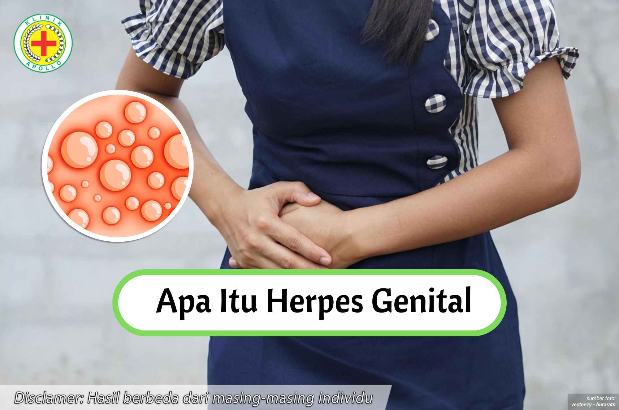 Ilustrasi Apa Itu Herpes Genital.