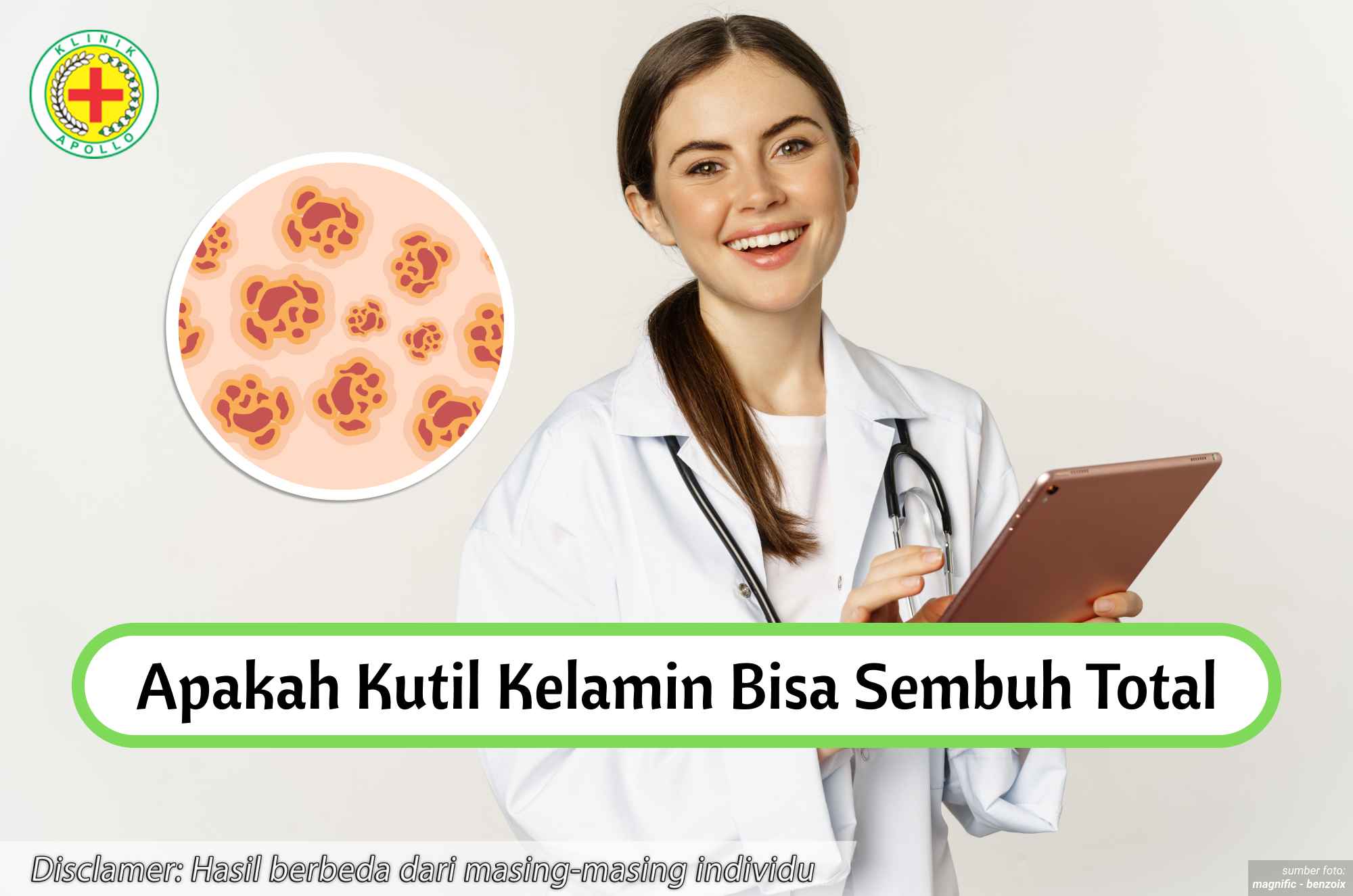Ilustrasi Apakah Kutil Kelamin Bisa Sembuh Total.