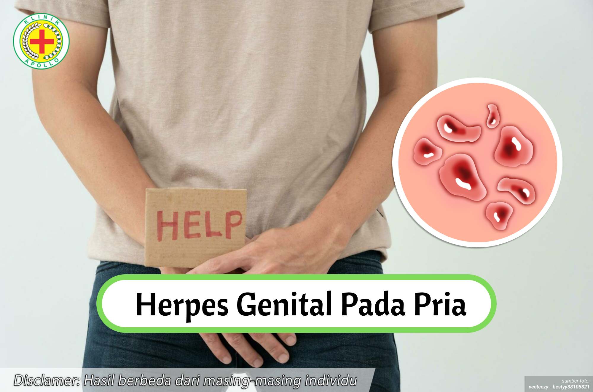 Ilustrasi Herpes Genital pada Pria.
