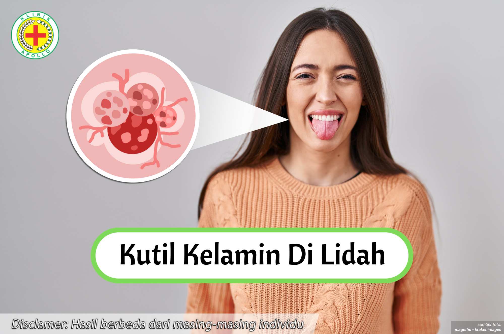 Ilustrasi Kutil Kelamin di Lidah.