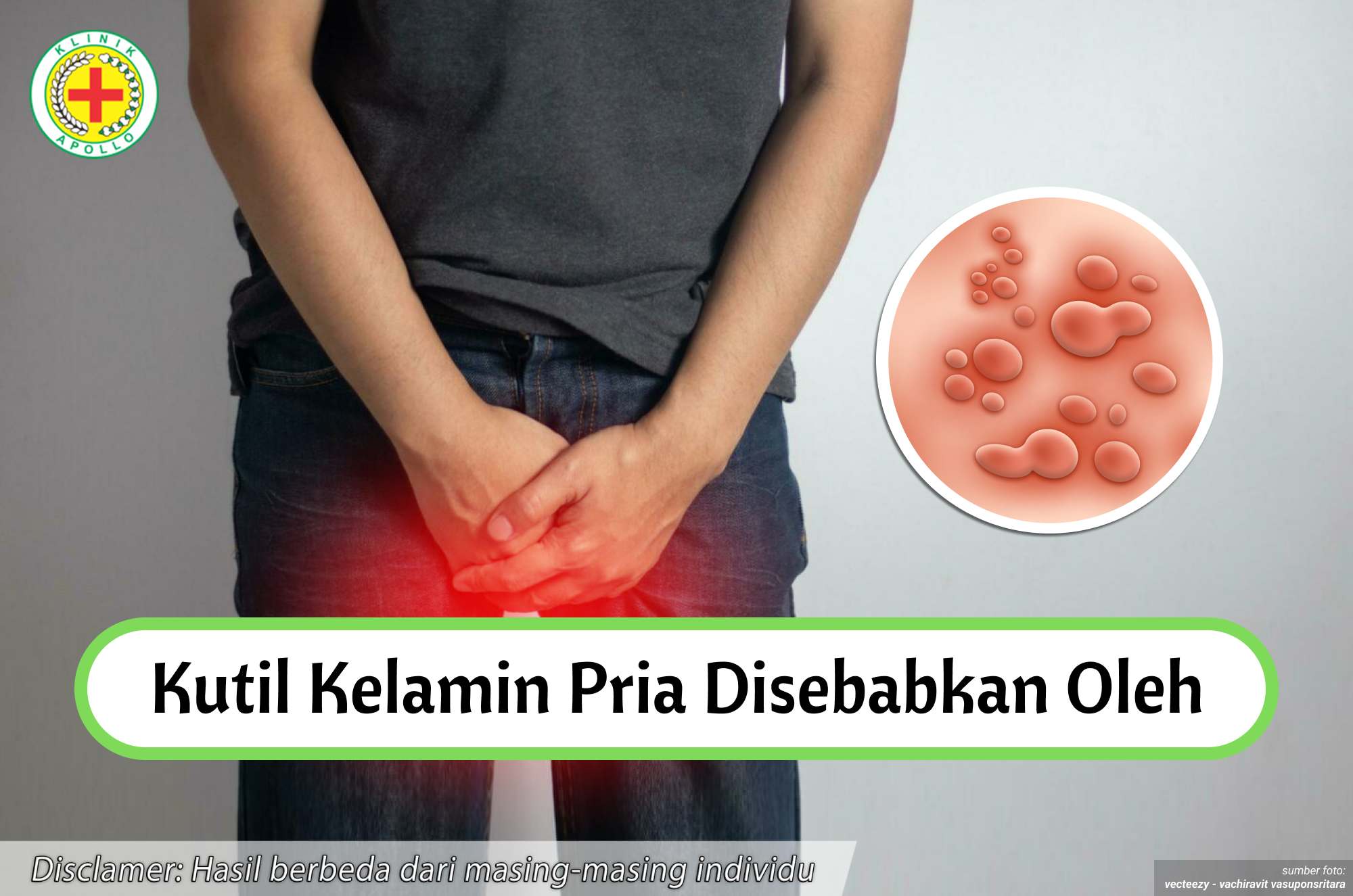 Ilustrasi Kutil Kelamin Pria Disebabkan Oleh.