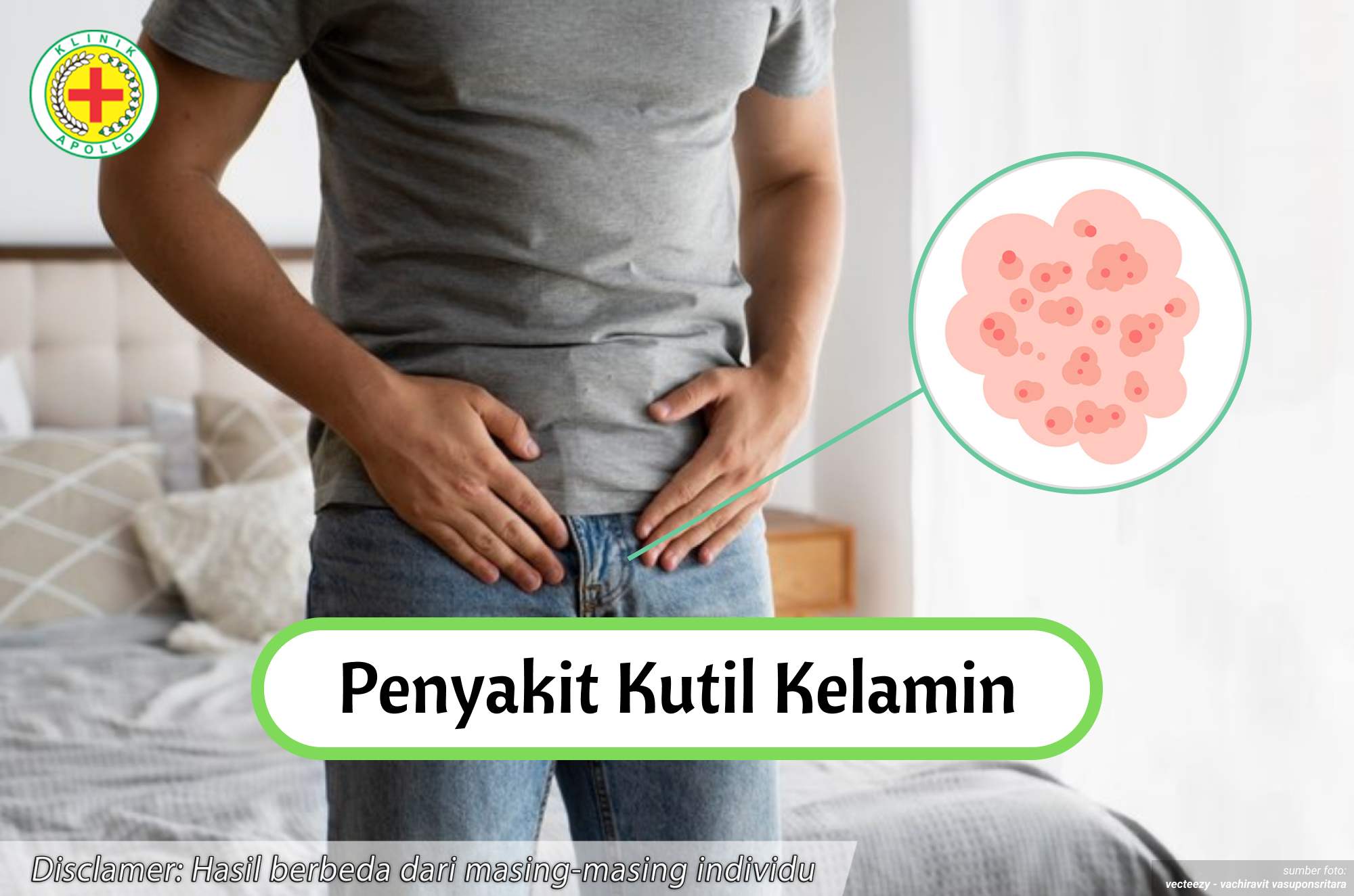 Ilustrasi Penyakit Kutil Kelamin.