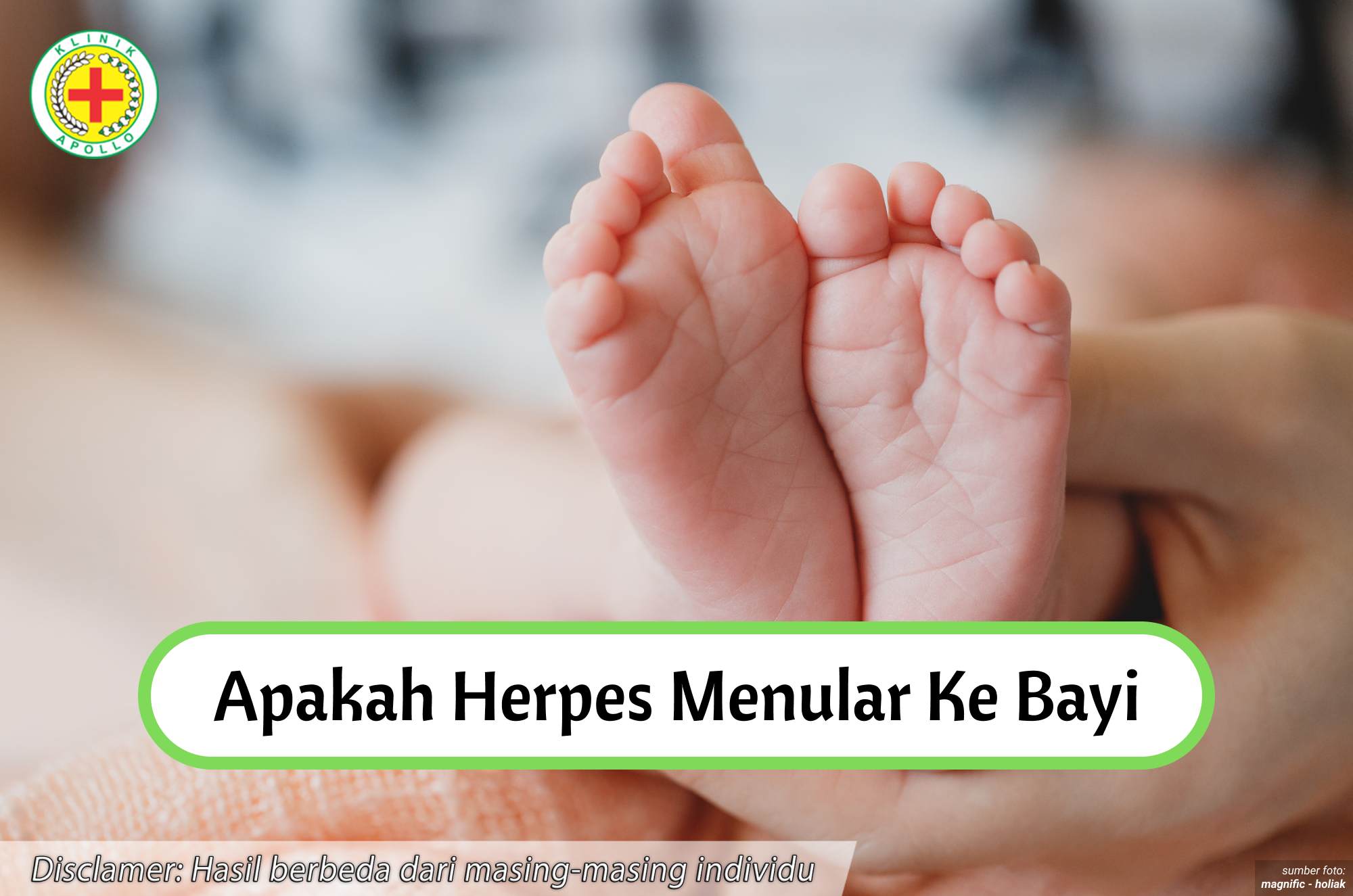 Ilustrasi Apakah Herpes Menular ke Bayi.