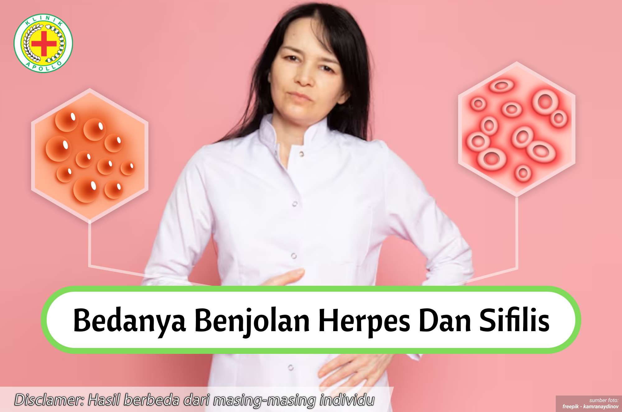 Ilustrasi Bedanya Benjolan Herpes dan Sifilis.