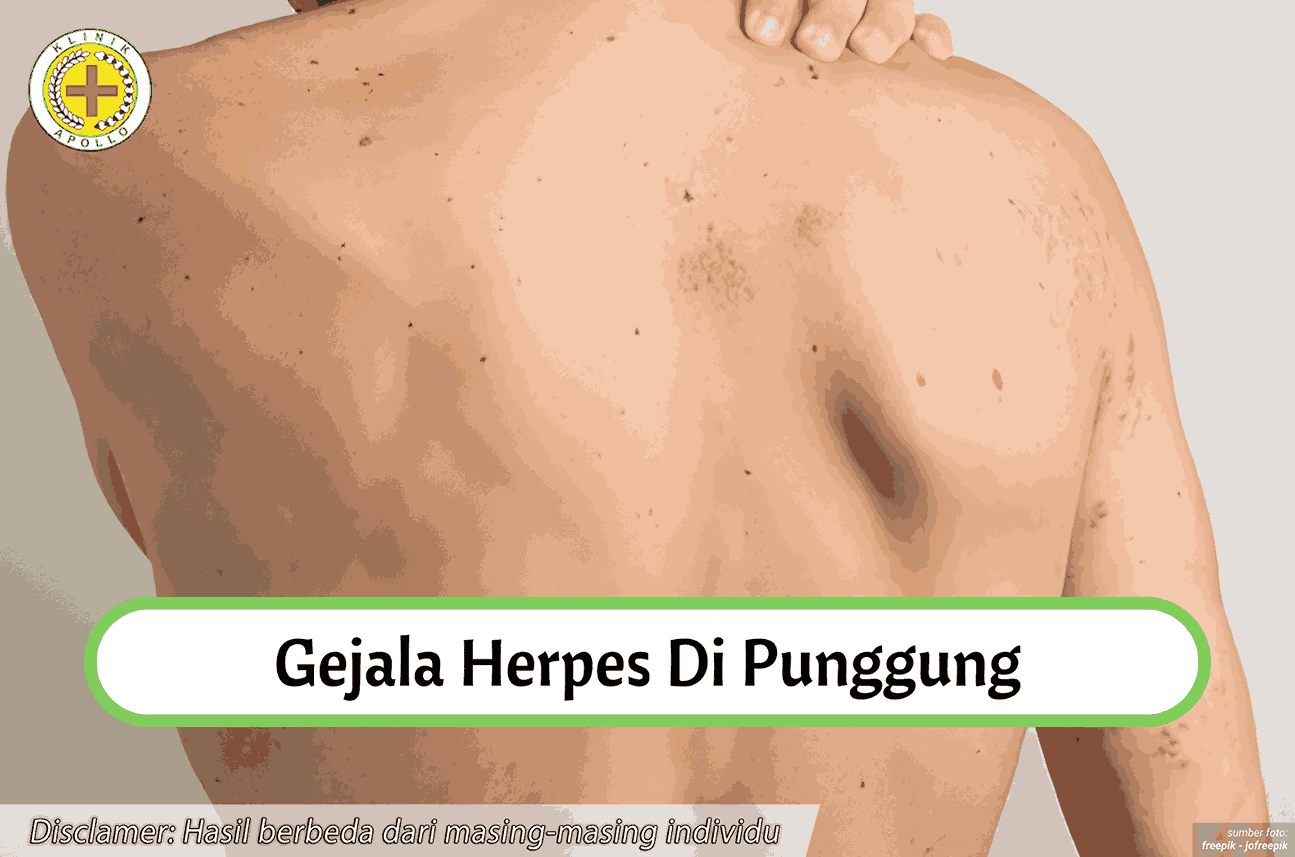 Ilustrasi Herpes di Punggung.