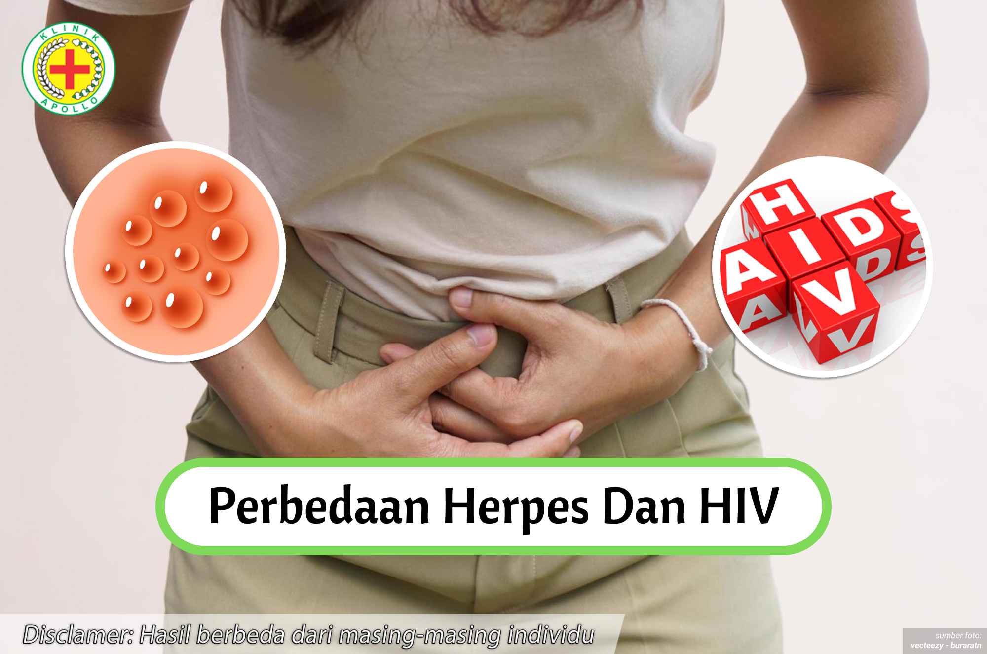 Ilustrasi Perbedaan Herpes dan HIV.