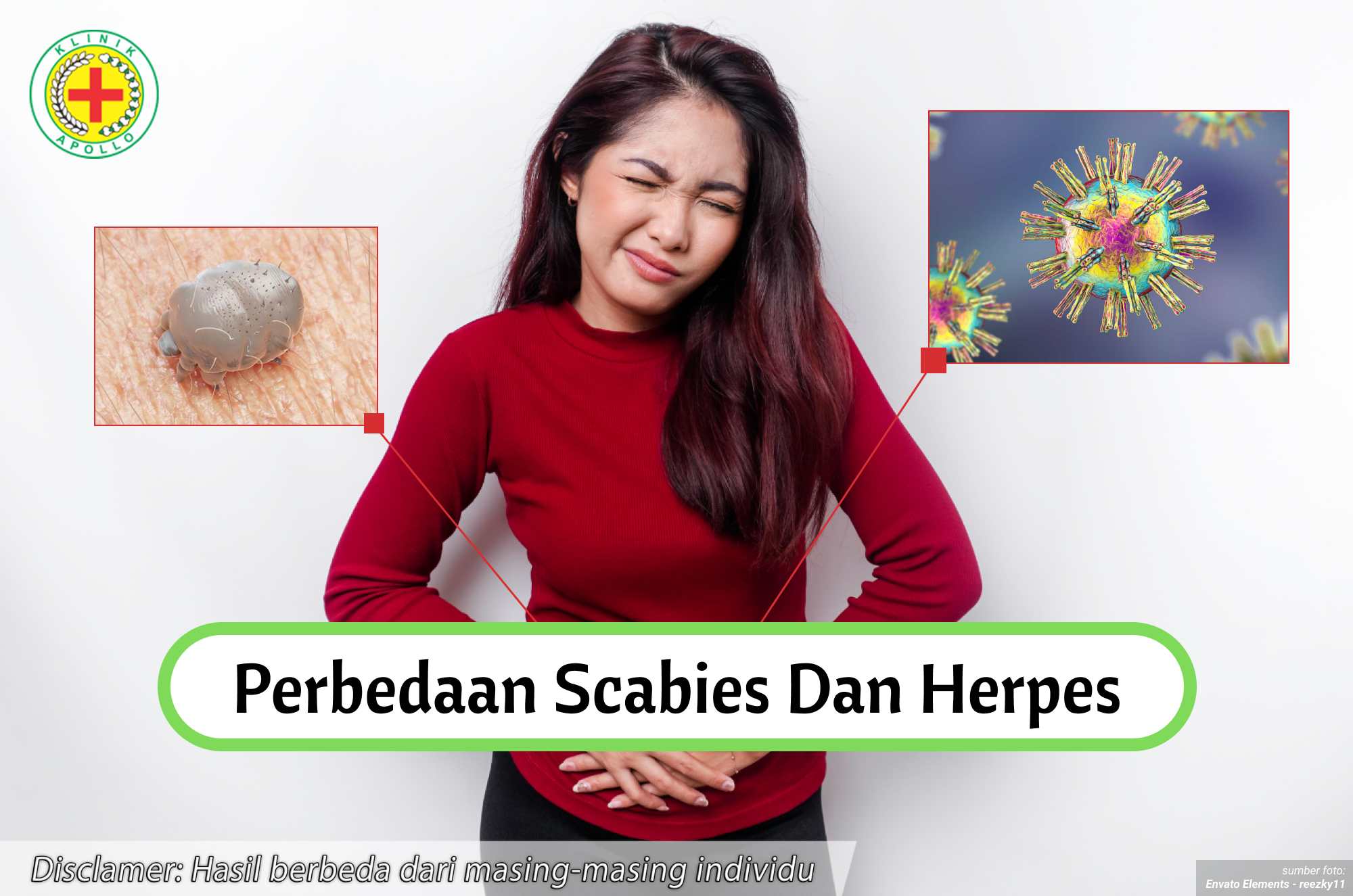 Ilustrasi Perbedaan Scabies dan Herpes.