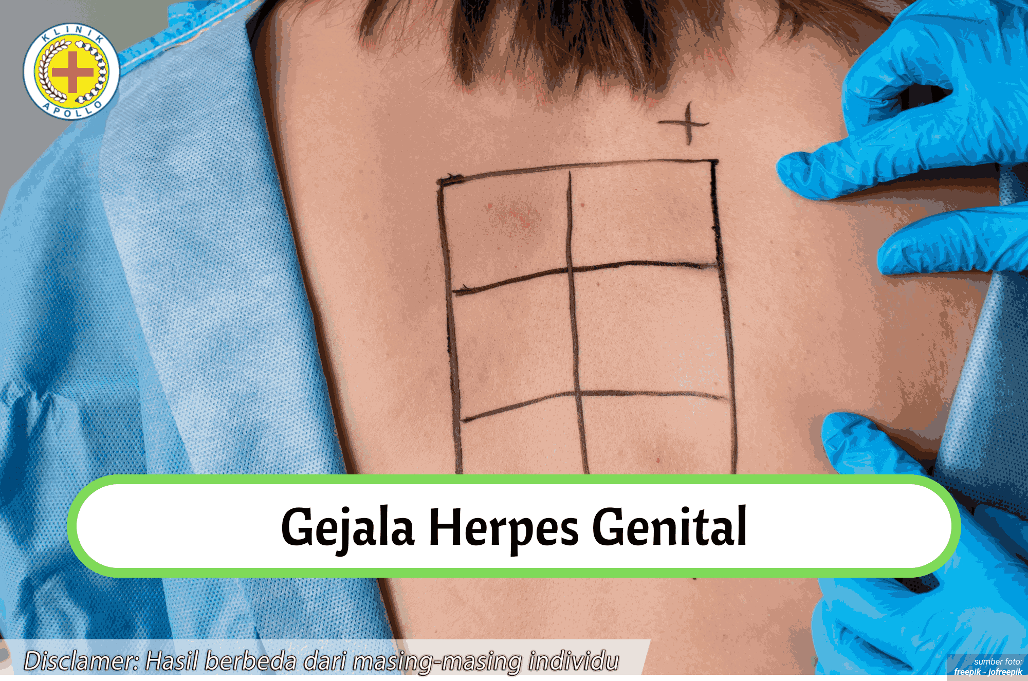 Ilustrasi Gejala Herpes Genital.