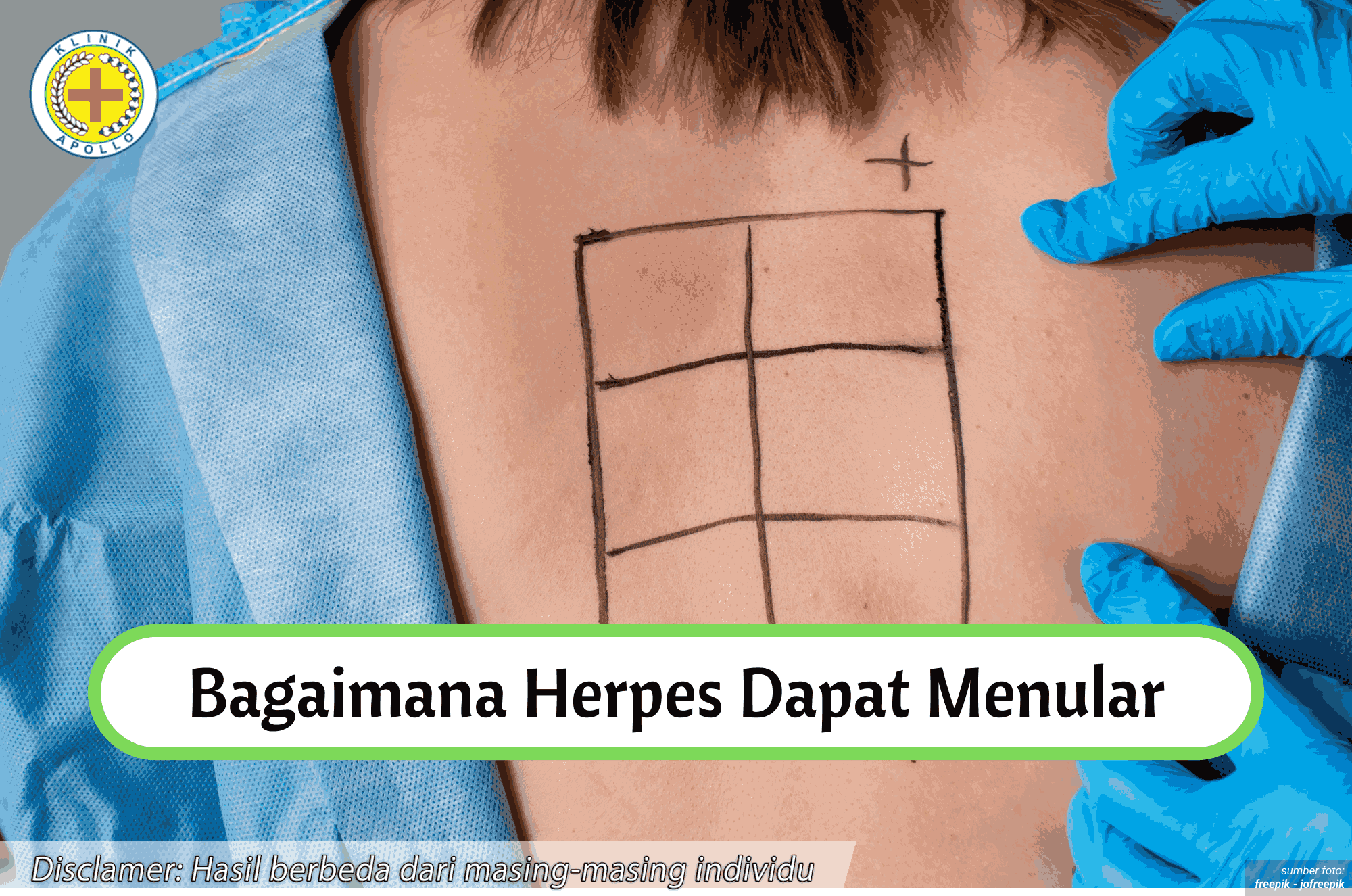 Ilustrasi Gejala Herpes Genital.