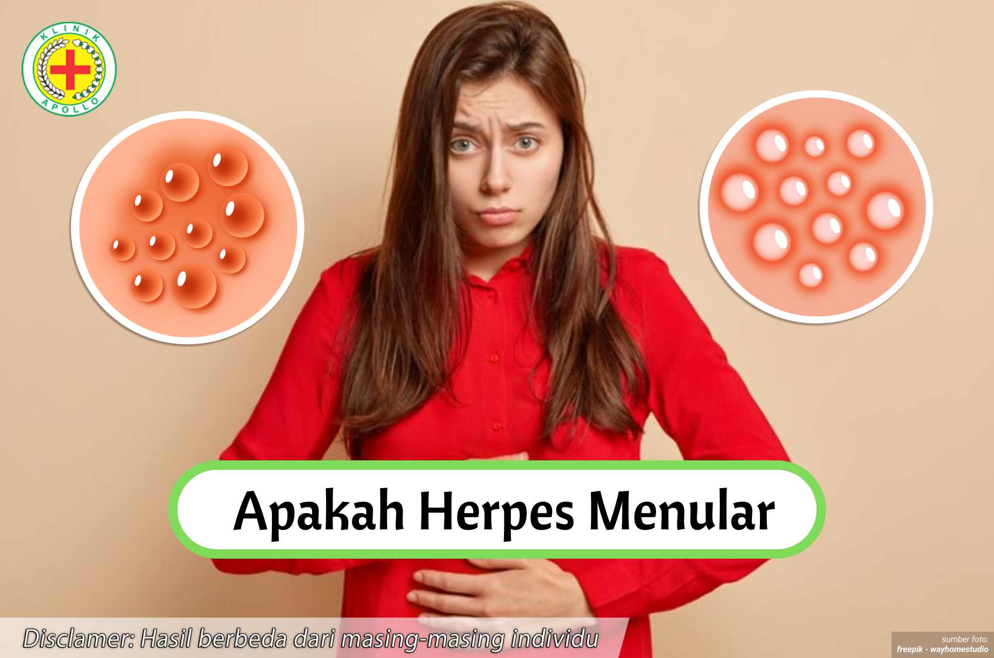 Ilustrasi Apakah Herpes Menular.