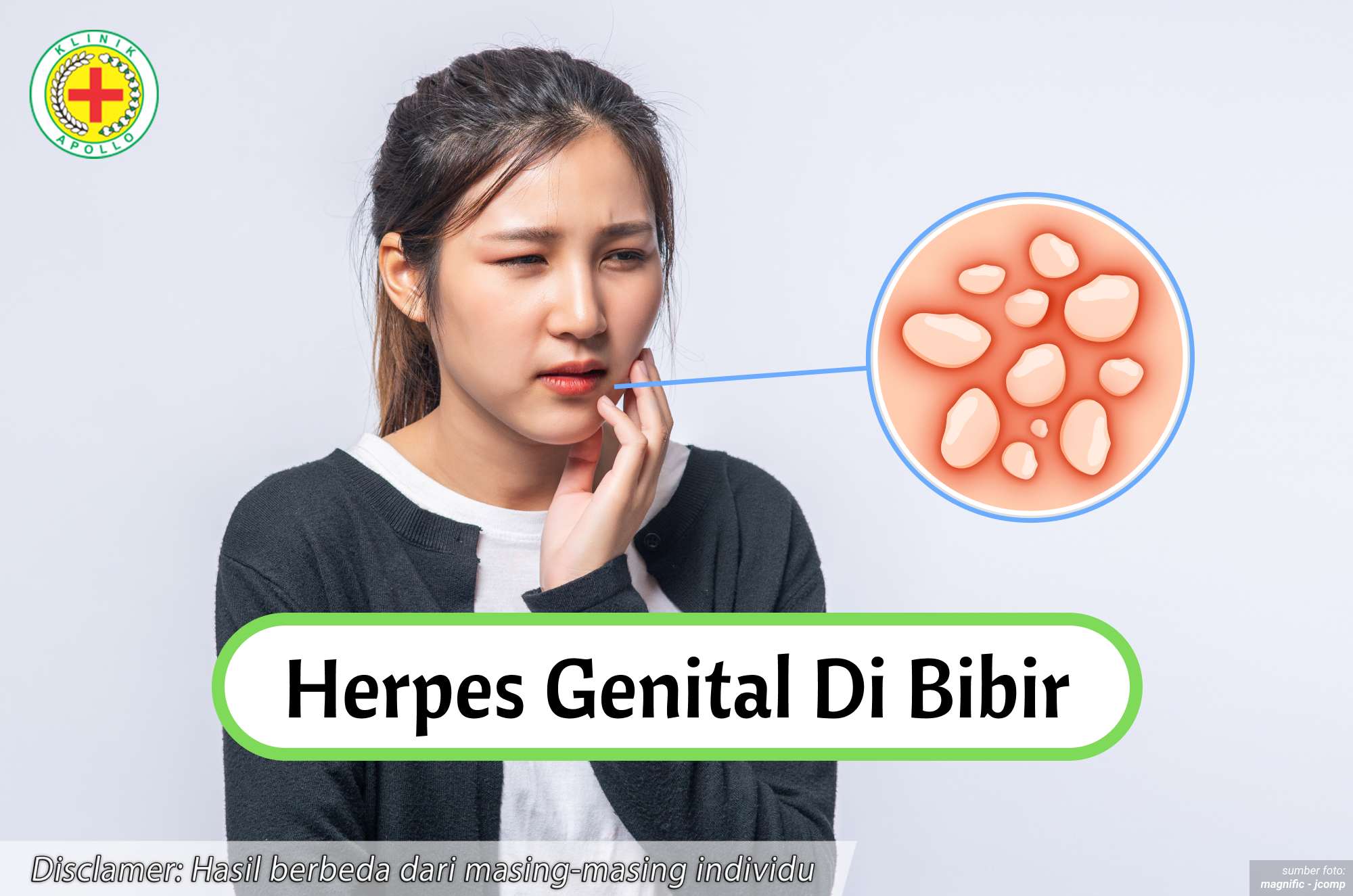 Ilustrasi Herpes Genital di Bibir.