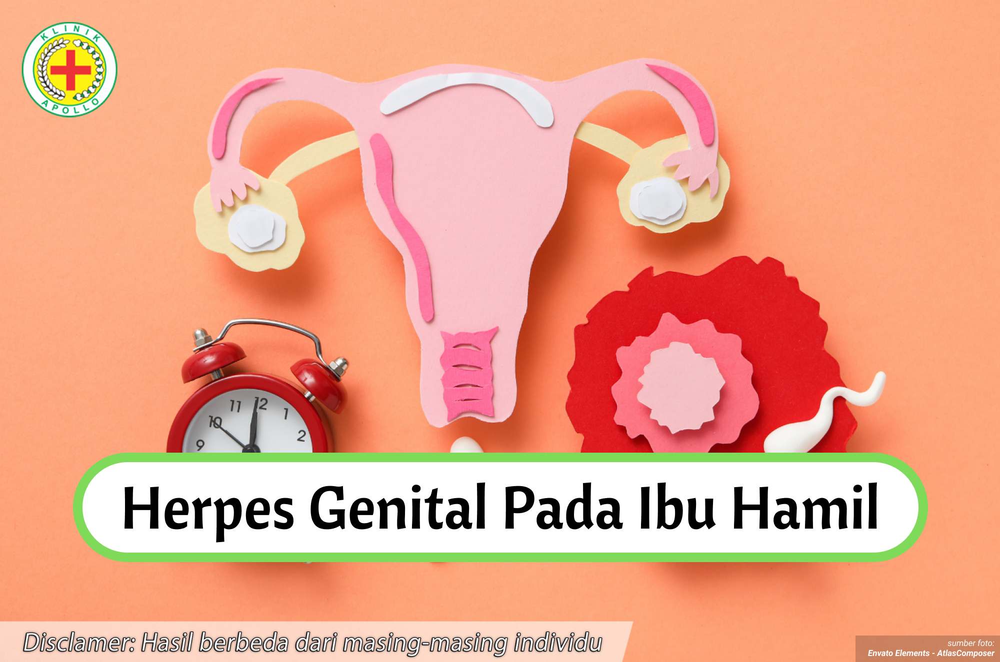 Ilustrasi Herpes Genital pada Ibu Hamil.