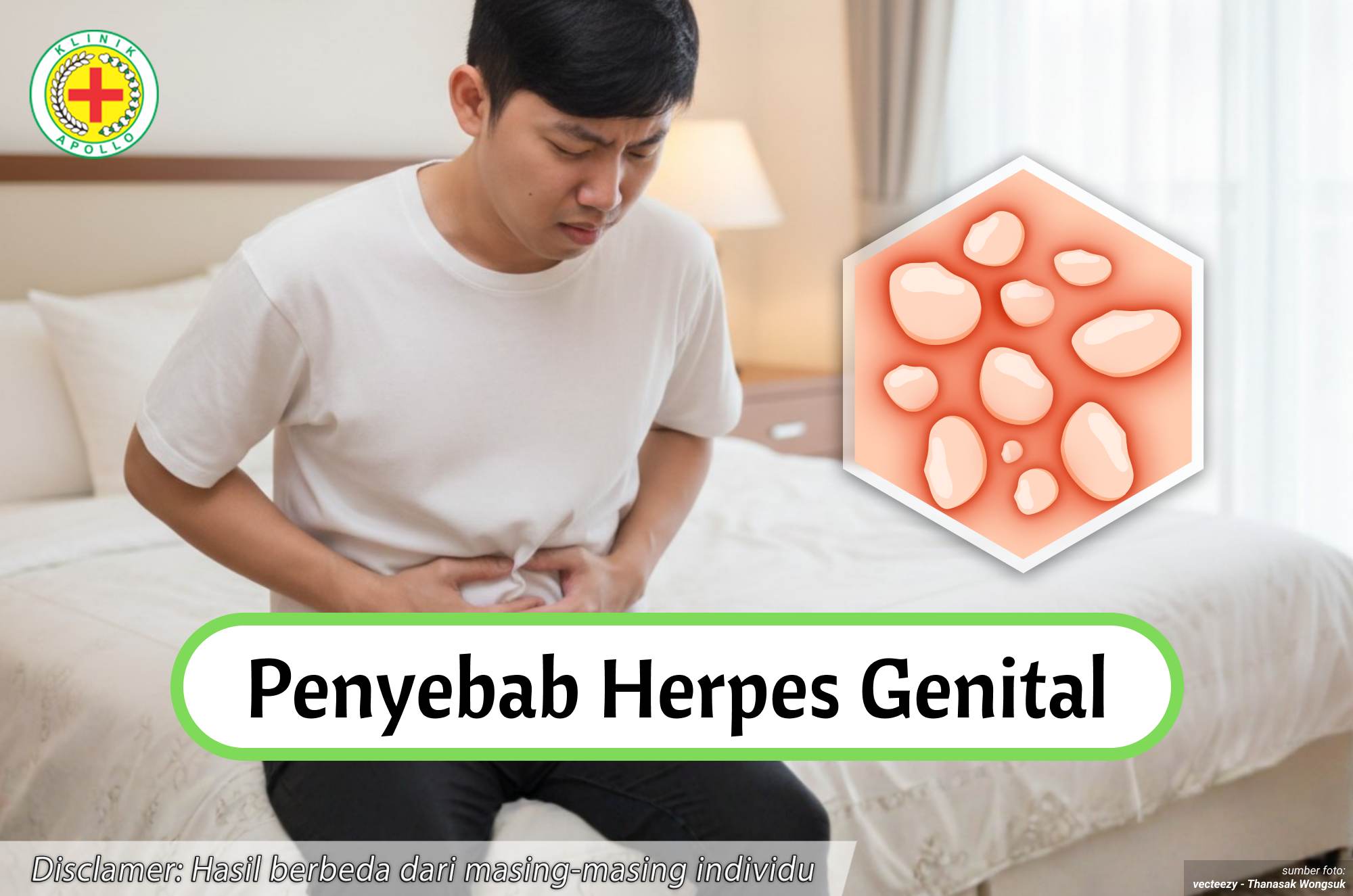 Ilustrasi Penyebab Herpes Genital.