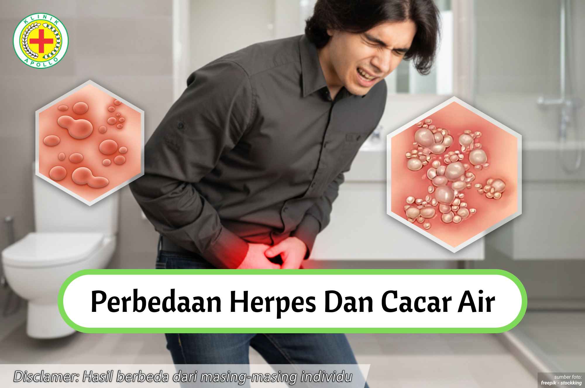 Ilustrasi Perbedaan Herpes dan Cacar Air.