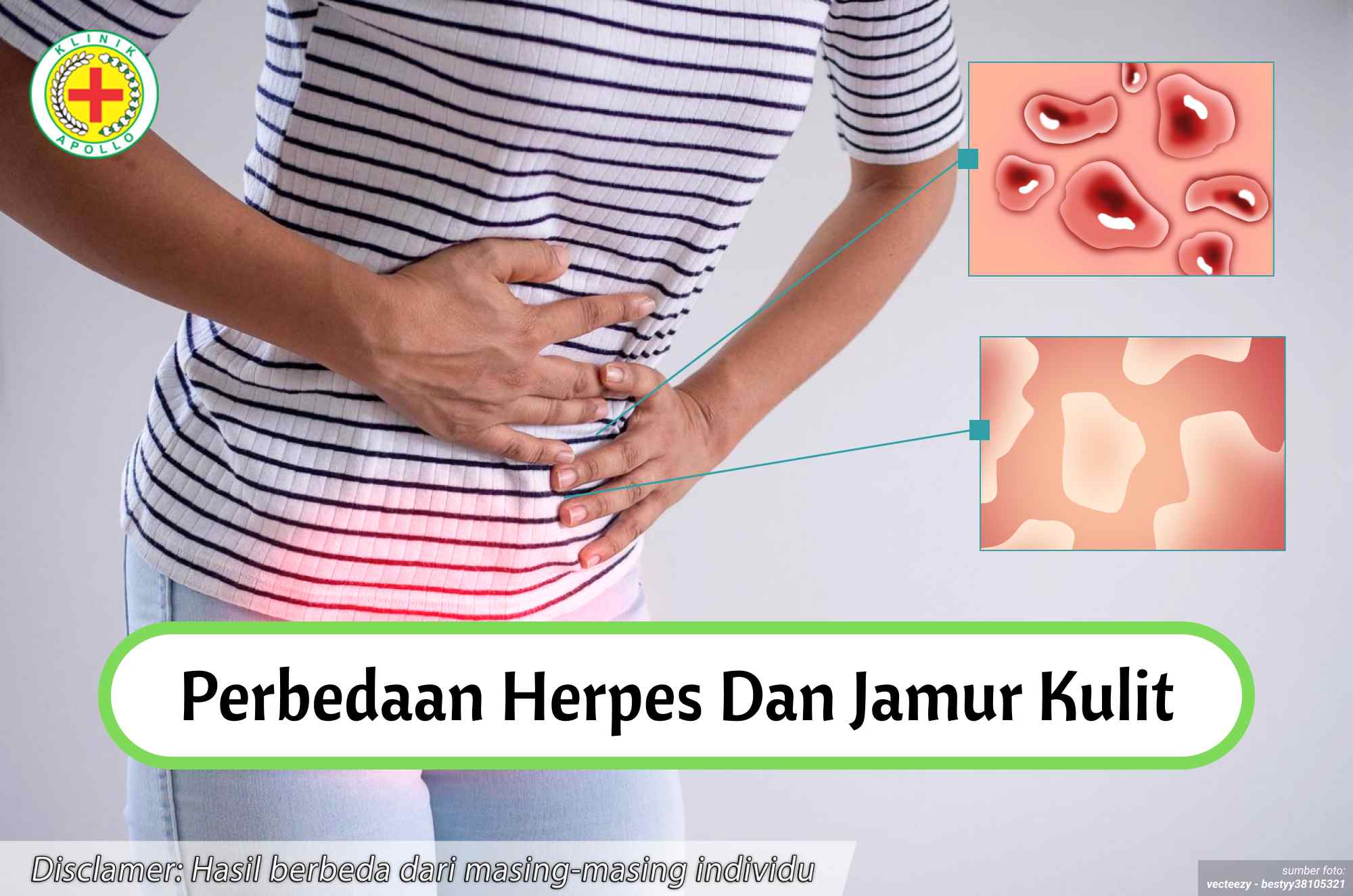 Ilustrasi Perbedaan Herpes dan Jamur Kulit.