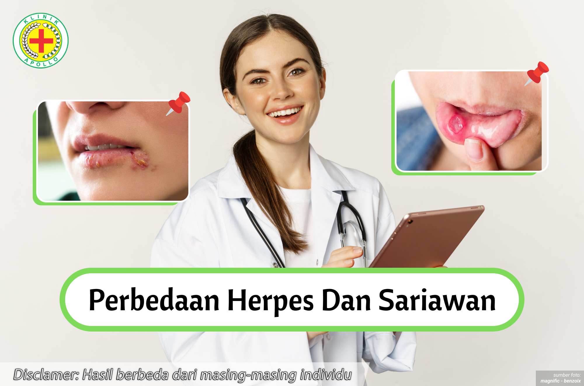 Ilustrasi Perbedaan Herpes dan Sariawan.