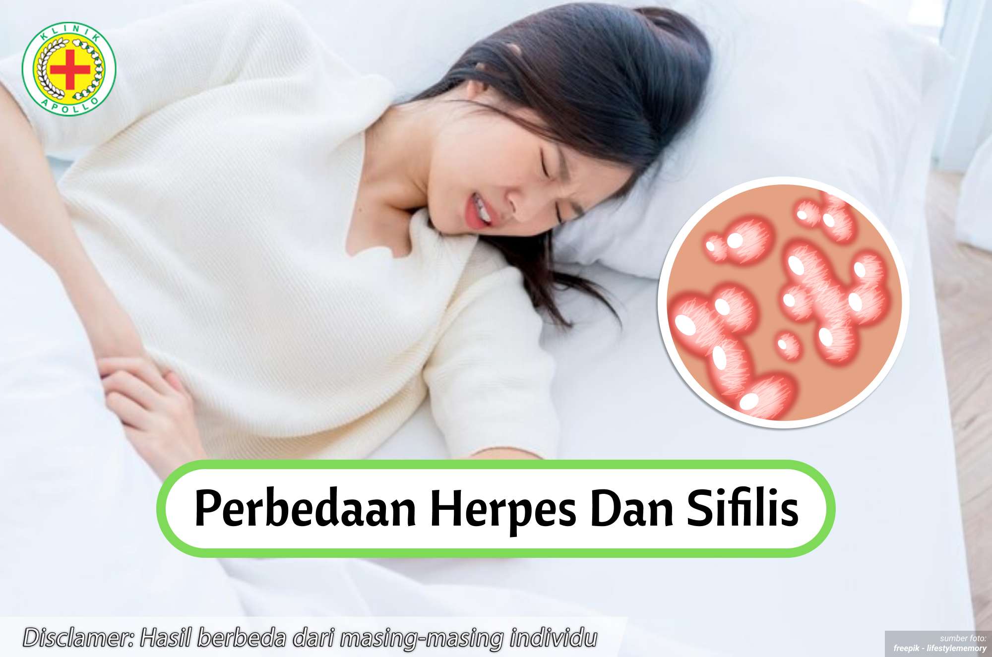 Ilustrasi Perbedaan Herpes dan Sifilis.