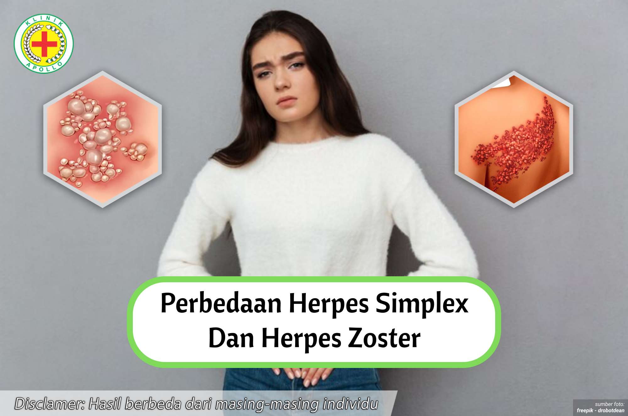 Ilustrasi Perbedaan Herpes Simplex dan Herpes Zoster.