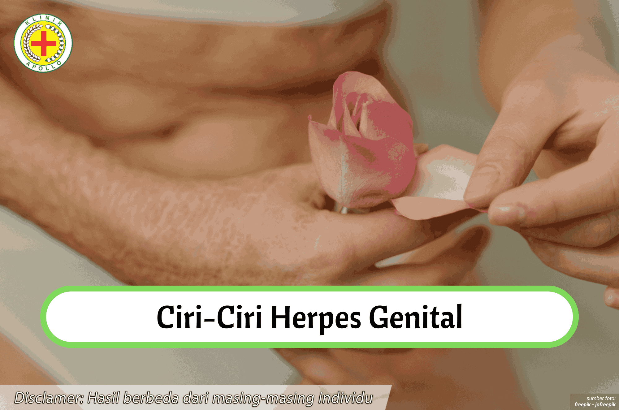 Ilustrasi Ciri-ciri Herpes Genital.