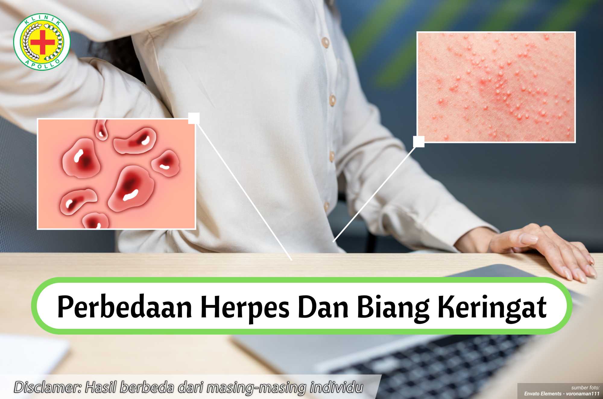 Ilustrasi Perbedaan Herpes dan Biang Keringat.